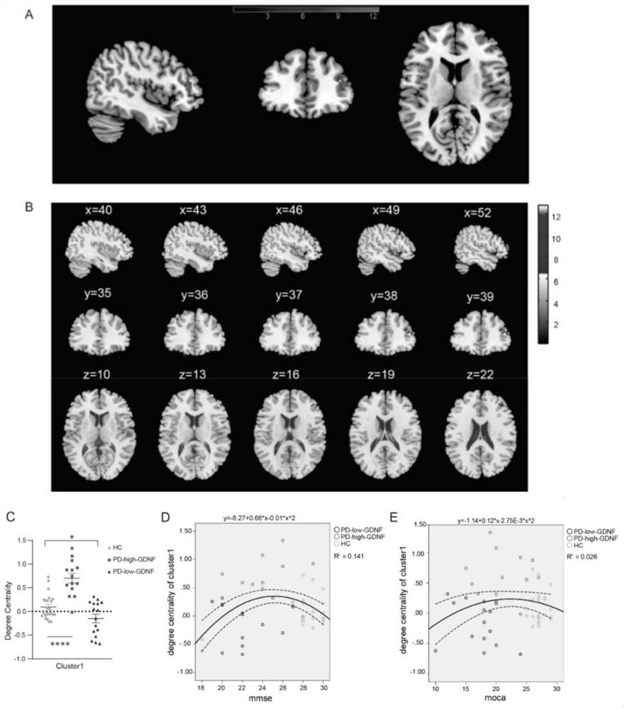 Method for judging cognitive impairment degree of Parkinson's disease by combining iconography with serum GDNF index