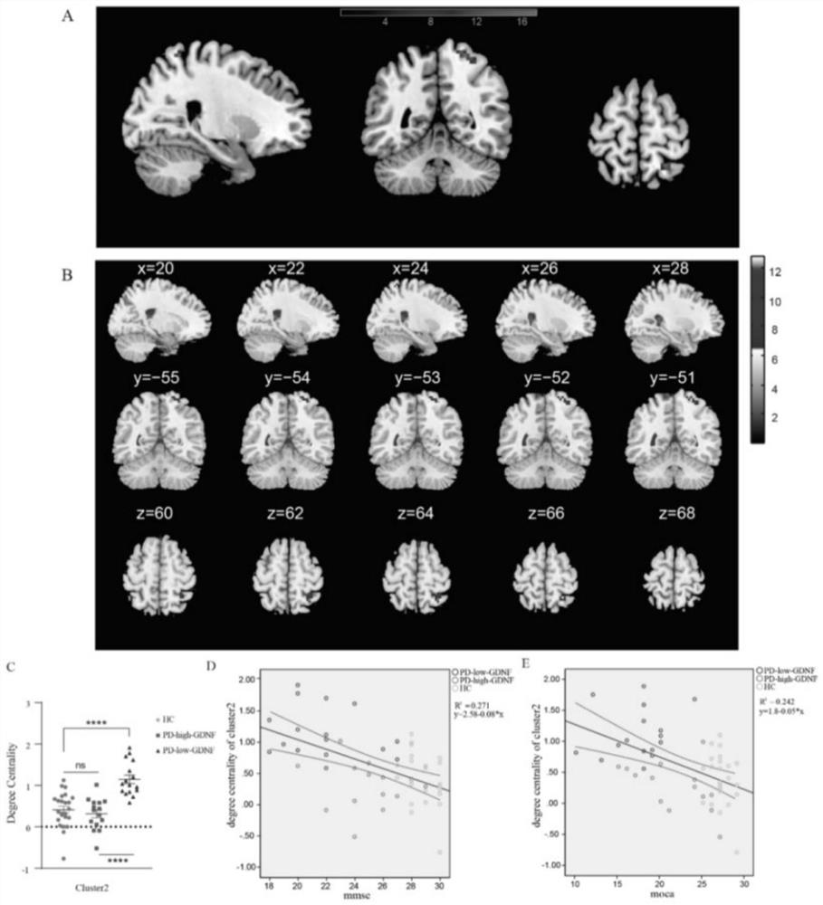 Method for judging cognitive impairment degree of Parkinson's disease by combining iconography with serum GDNF index