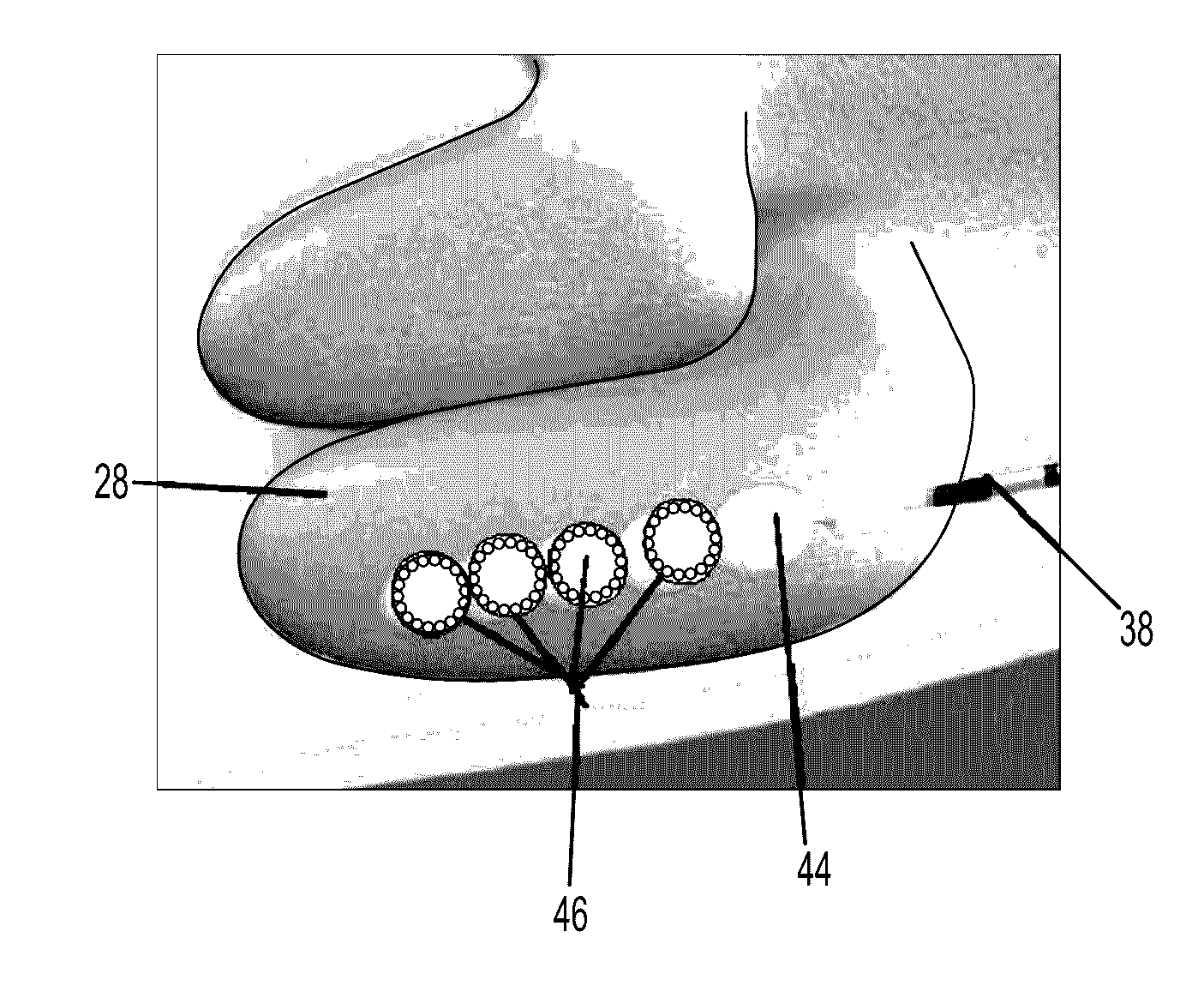 Treatment method for the inferior turbinate