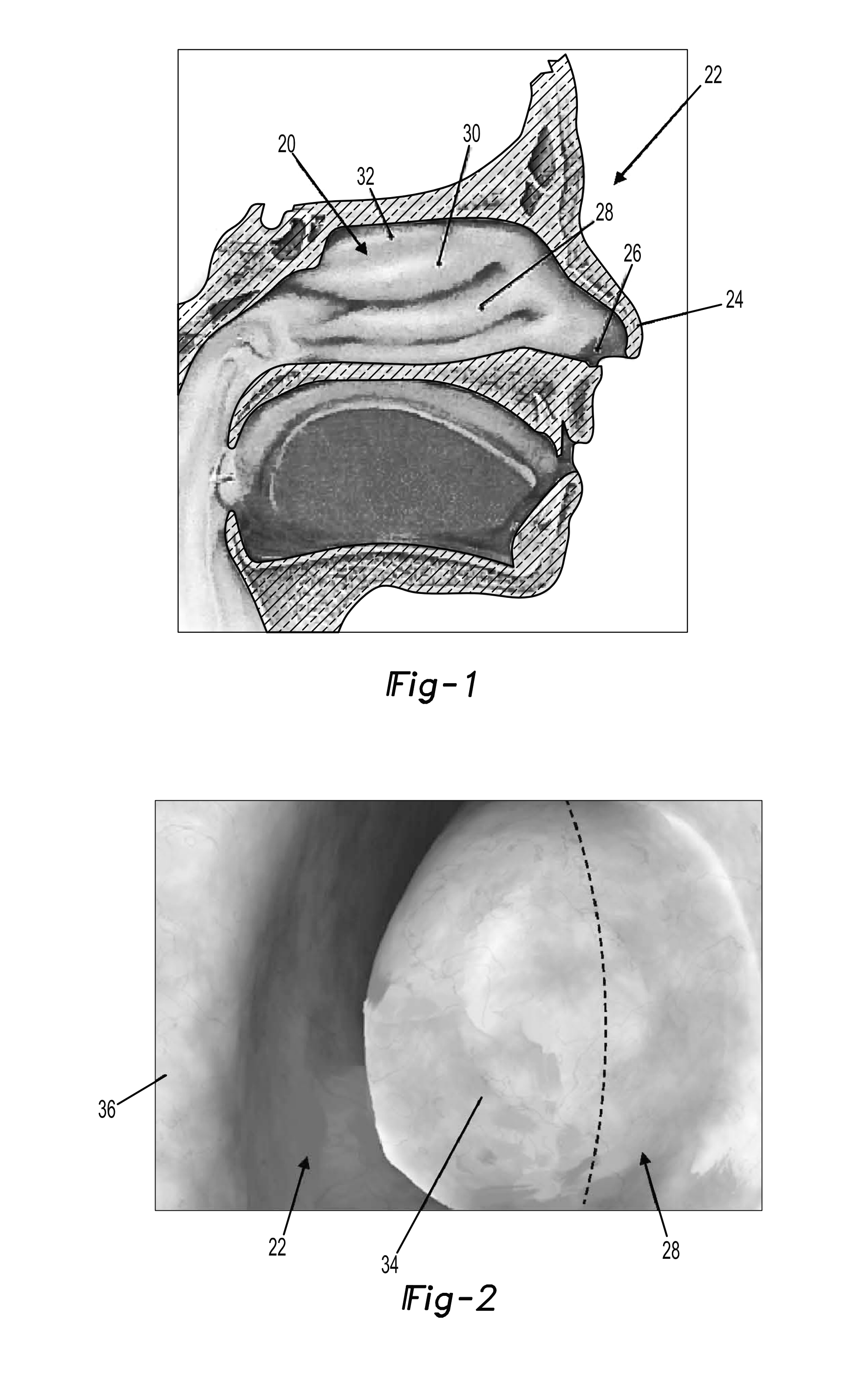 Treatment method for the inferior turbinate