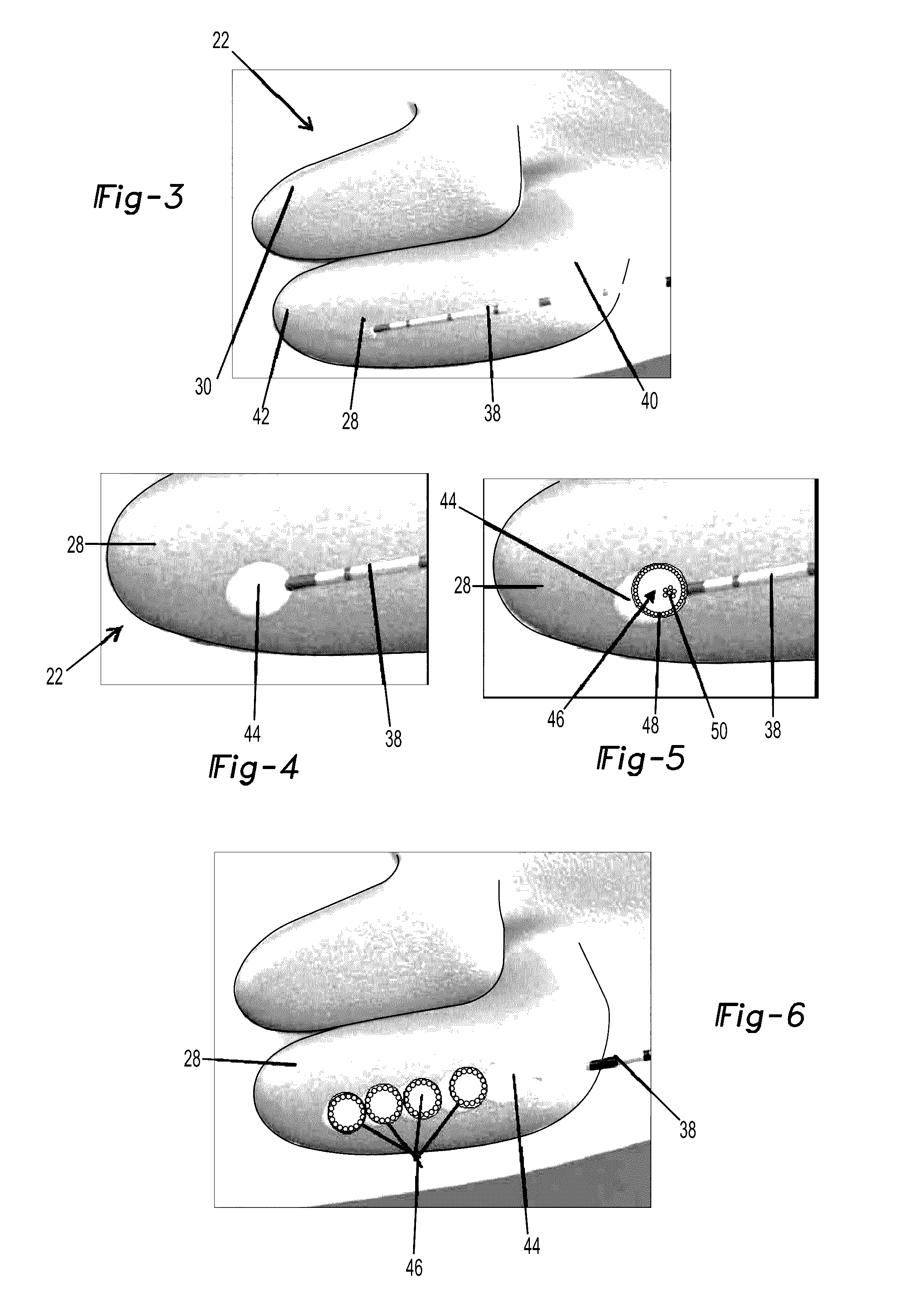 Treatment method for the inferior turbinate