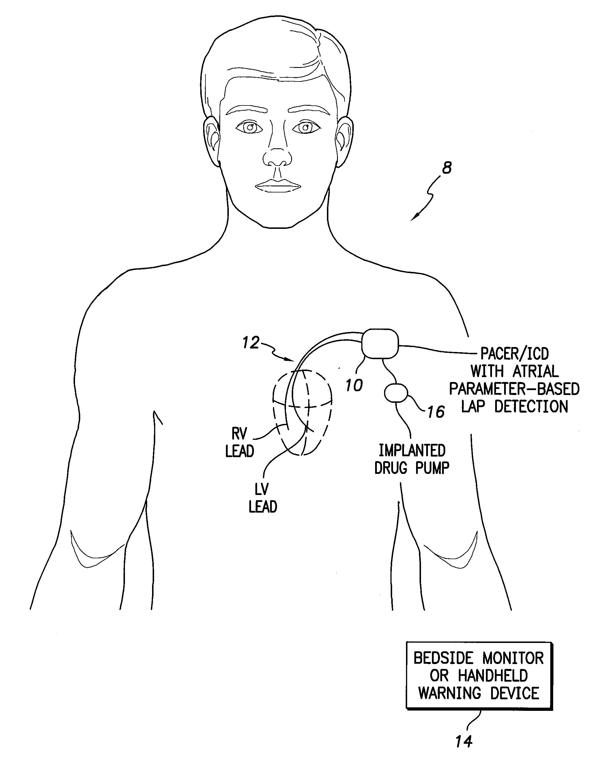 System and method for exploiting atrial eelctrocardiac parameters in assessing left atrial pressure using an implantable medical device