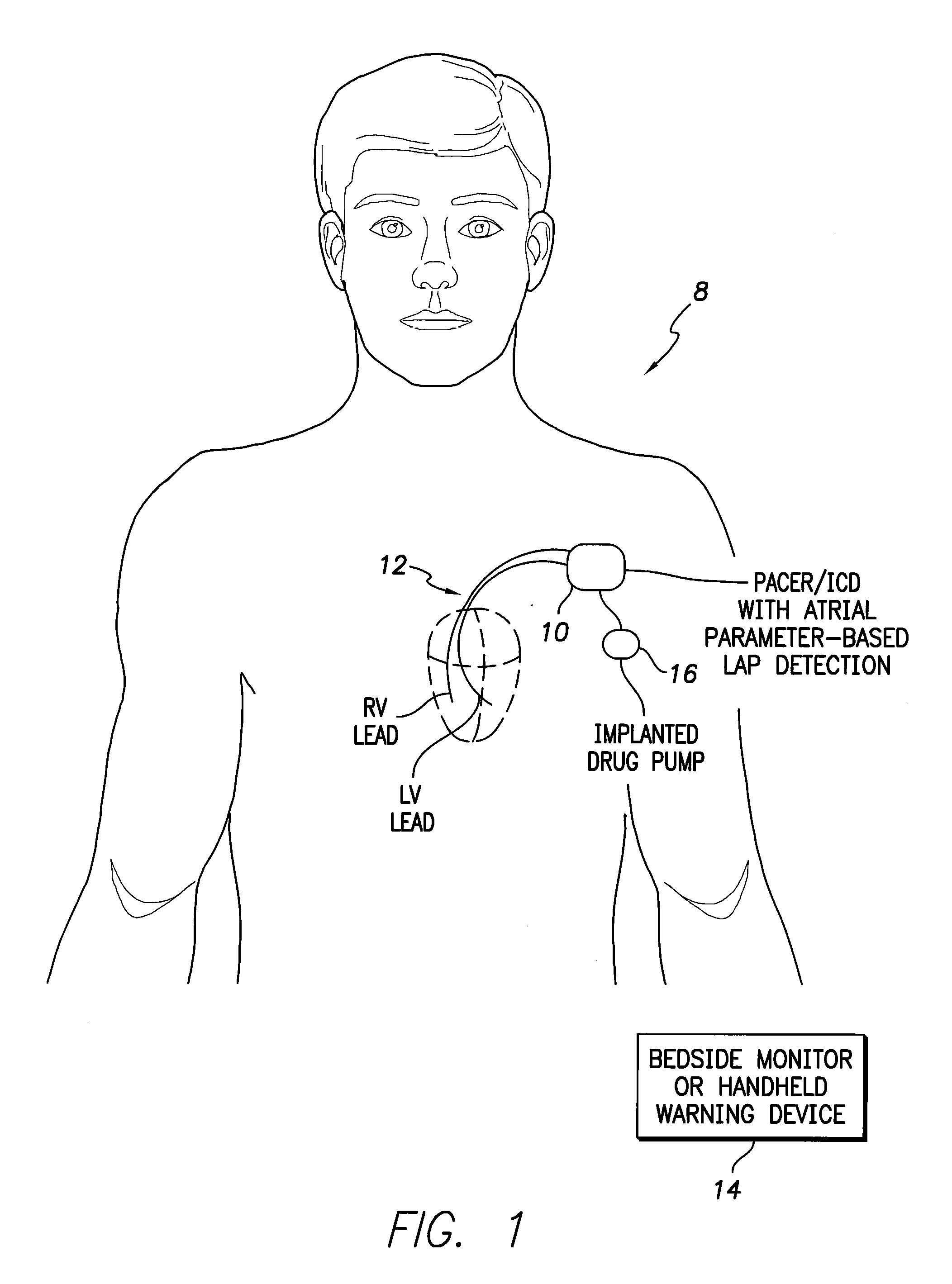 System and method for exploiting atrial eelctrocardiac parameters in assessing left atrial pressure using an implantable medical device