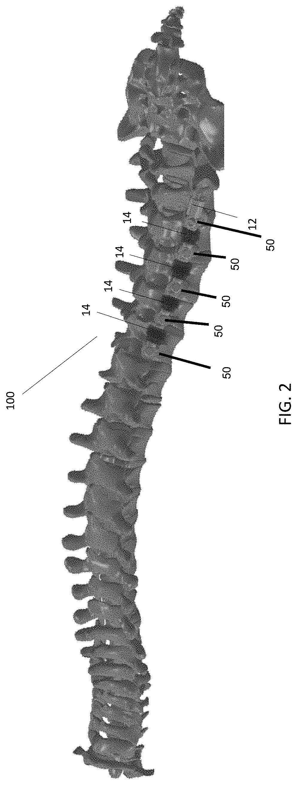 Spinal alignment system with thermally actuated component