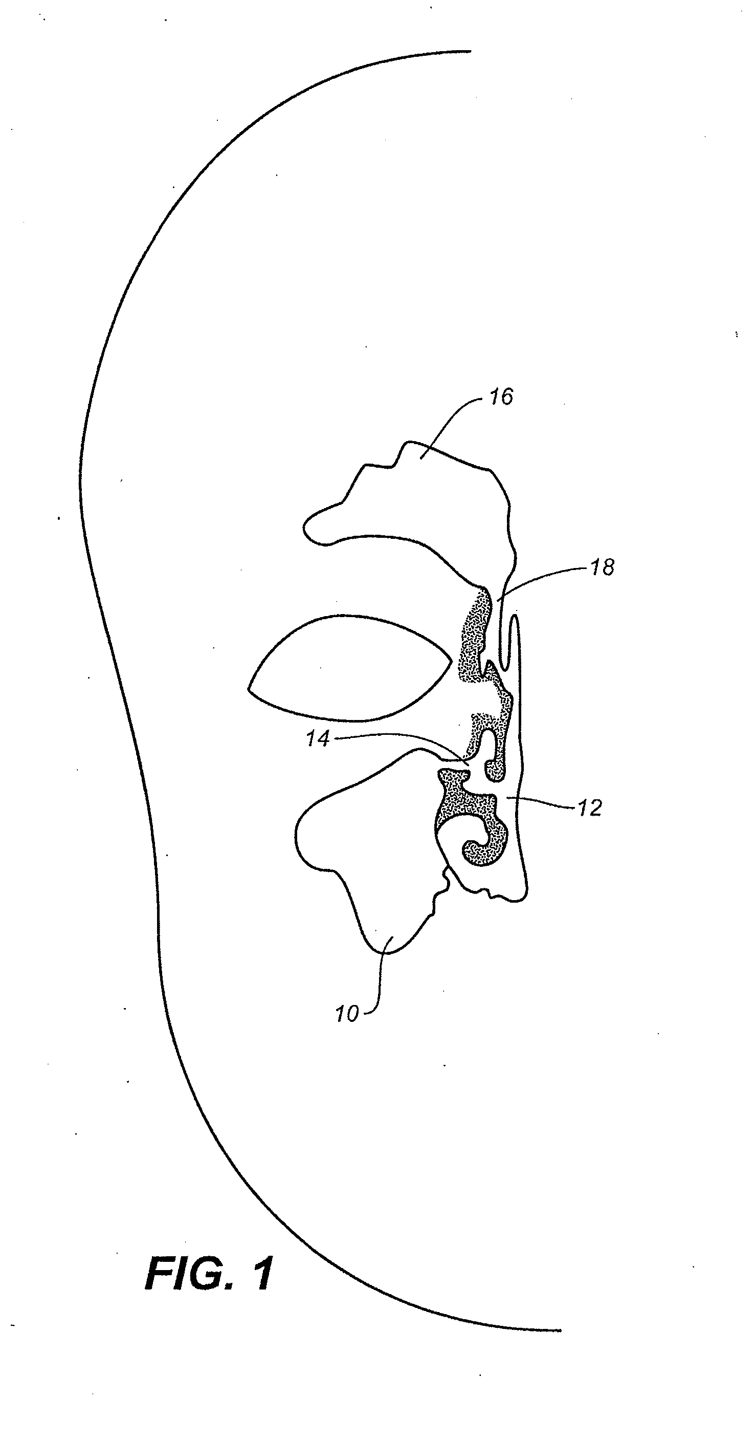 Device and methods for treating paranasal sinus conditions
