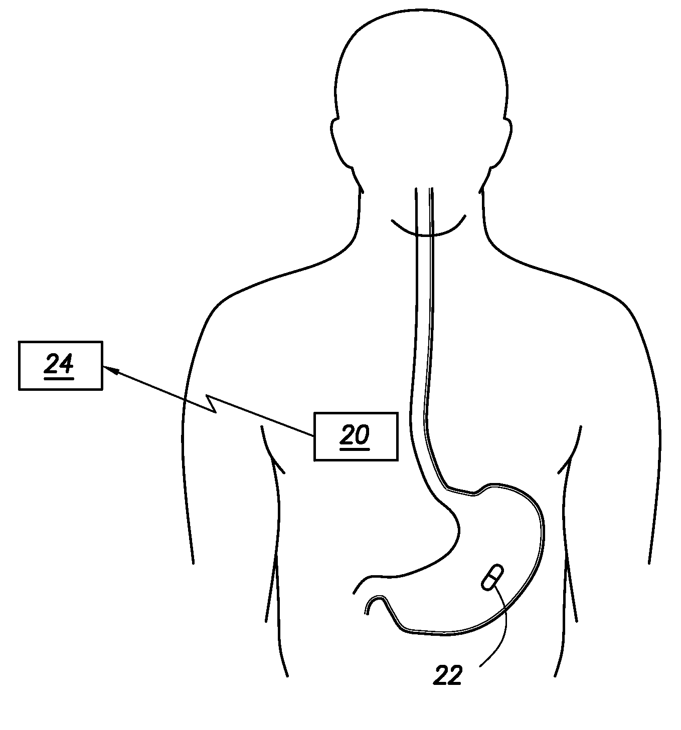Evaluation of gastrointestinal function using portable electroviscerography systems and methods of using the same