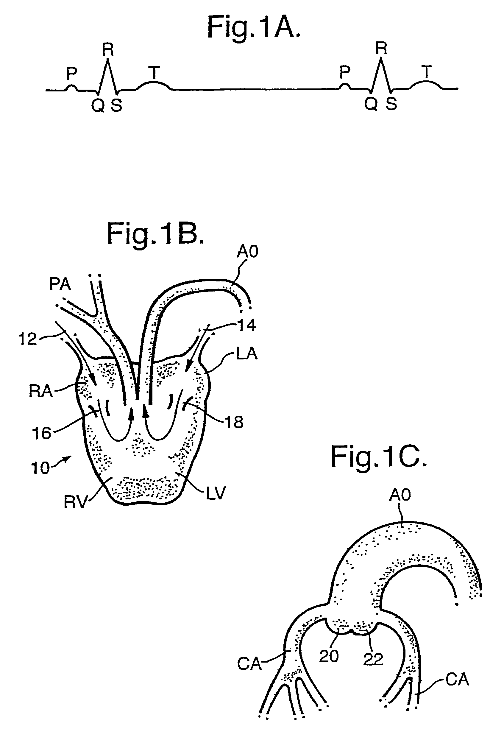 Counter pulsation electrotherapy apparatus for treating a person or a mammal