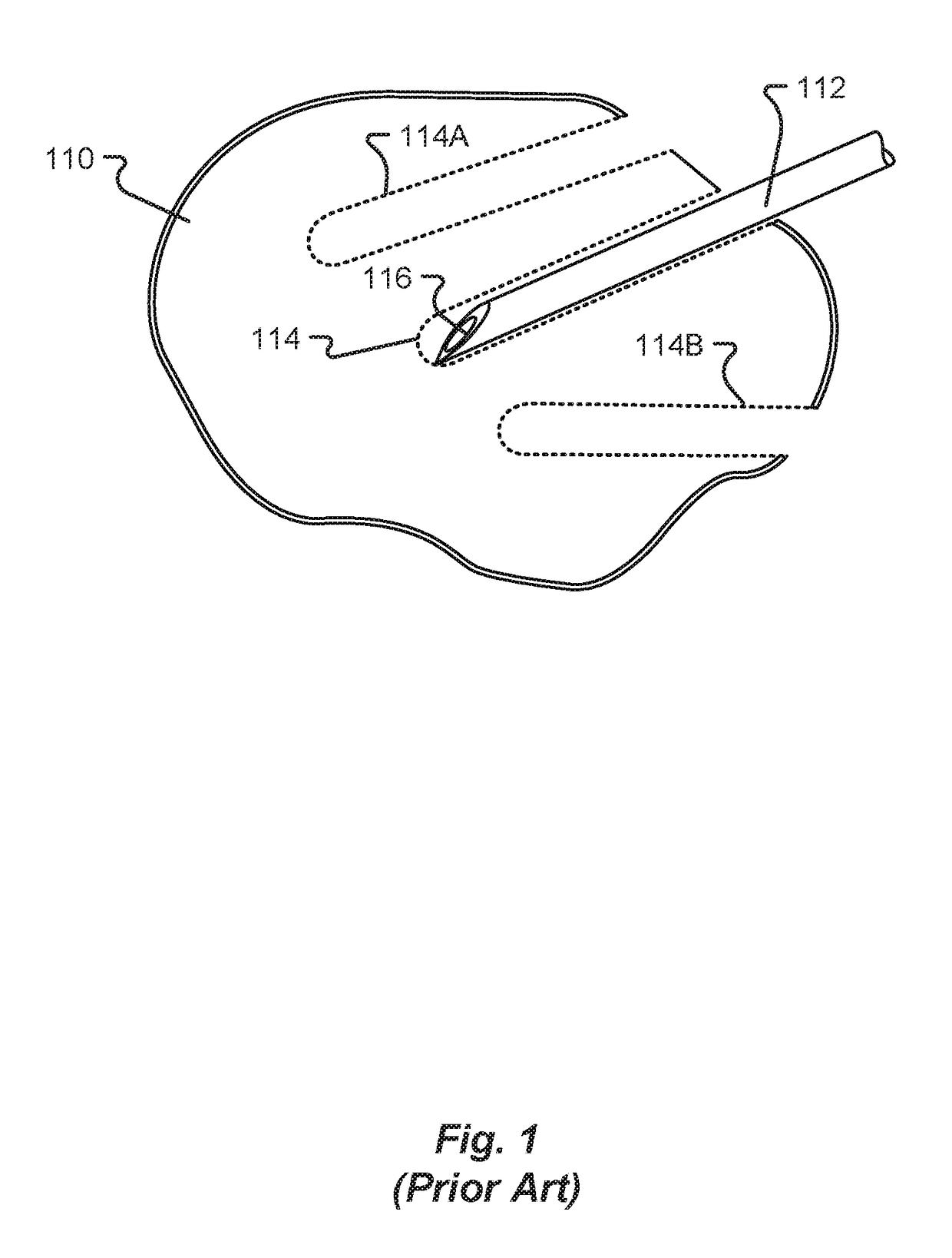 Stylet and Needle Combinations Used to Collect Tissue Samples During Endoscopic Procedures