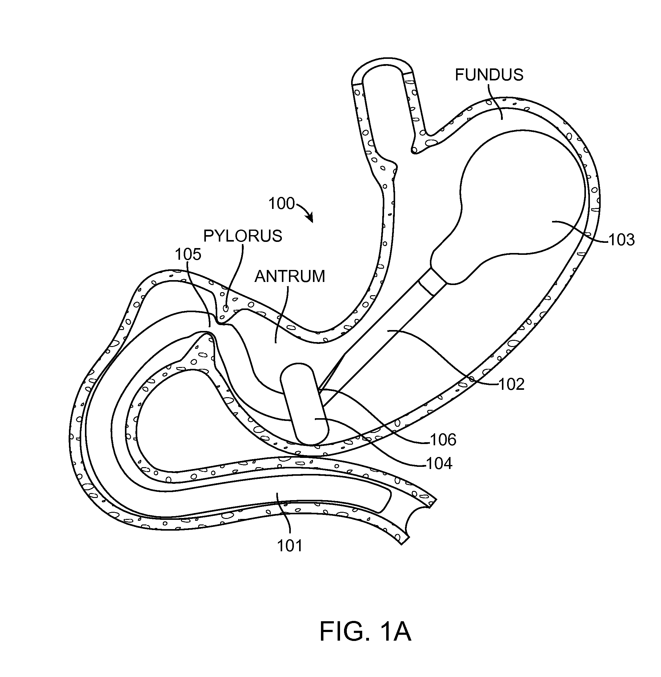 Intragastric implant devices