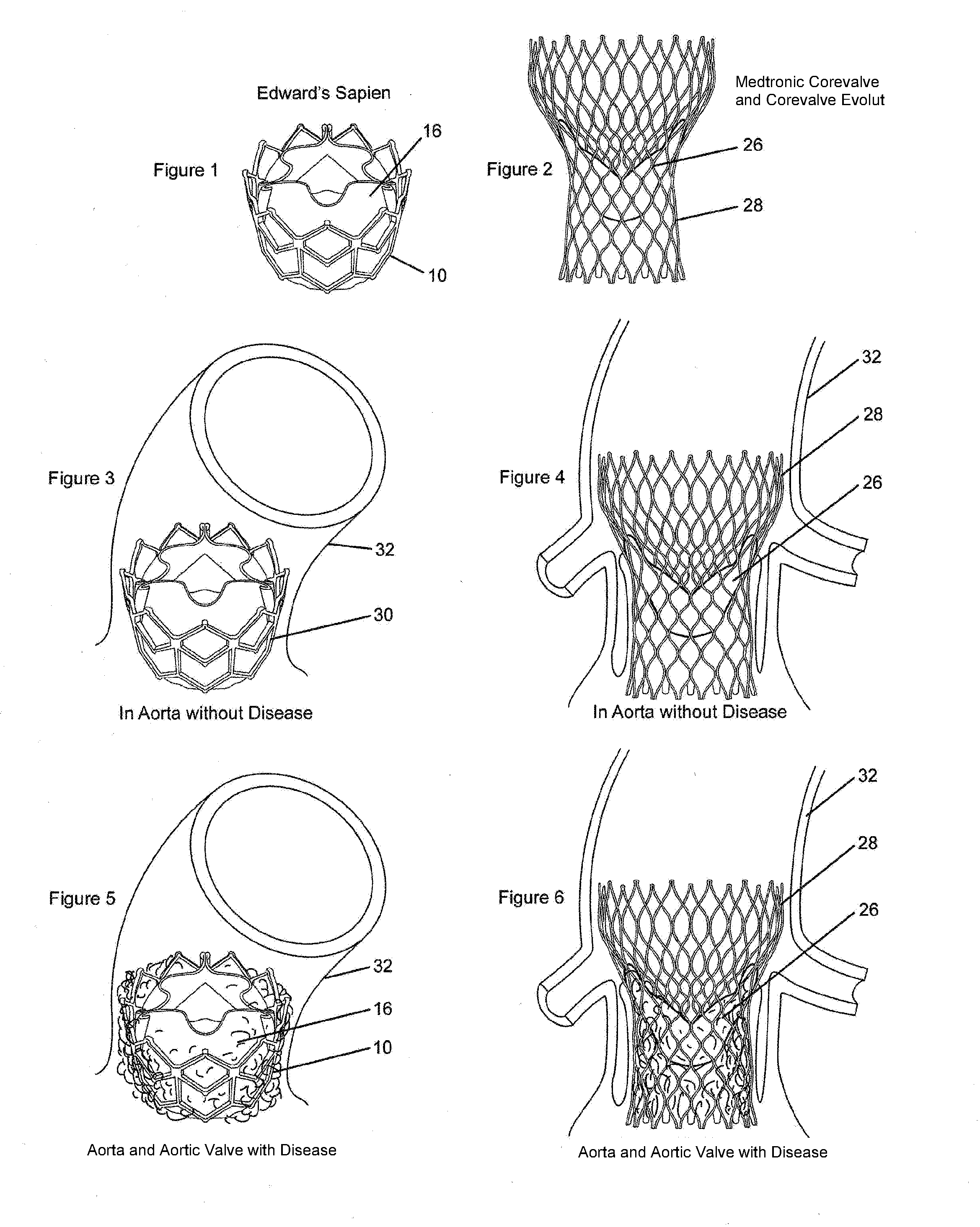 Methods for inhibiting stenosis, obstruction, or calcification of a stented heart valve or bioprosthesis
