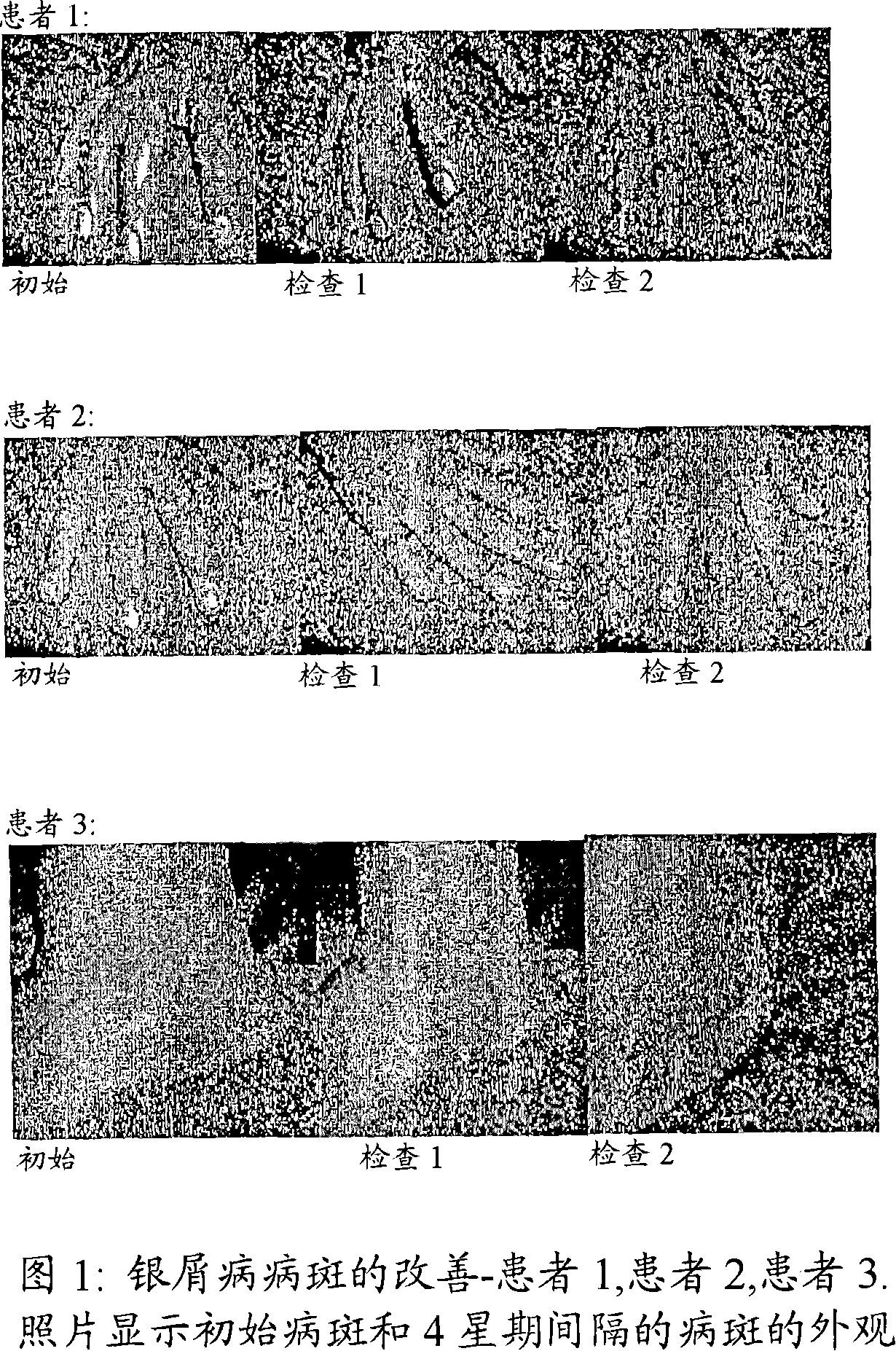 Compositions and methods for the management of hyperproliferative dermatological conditions
