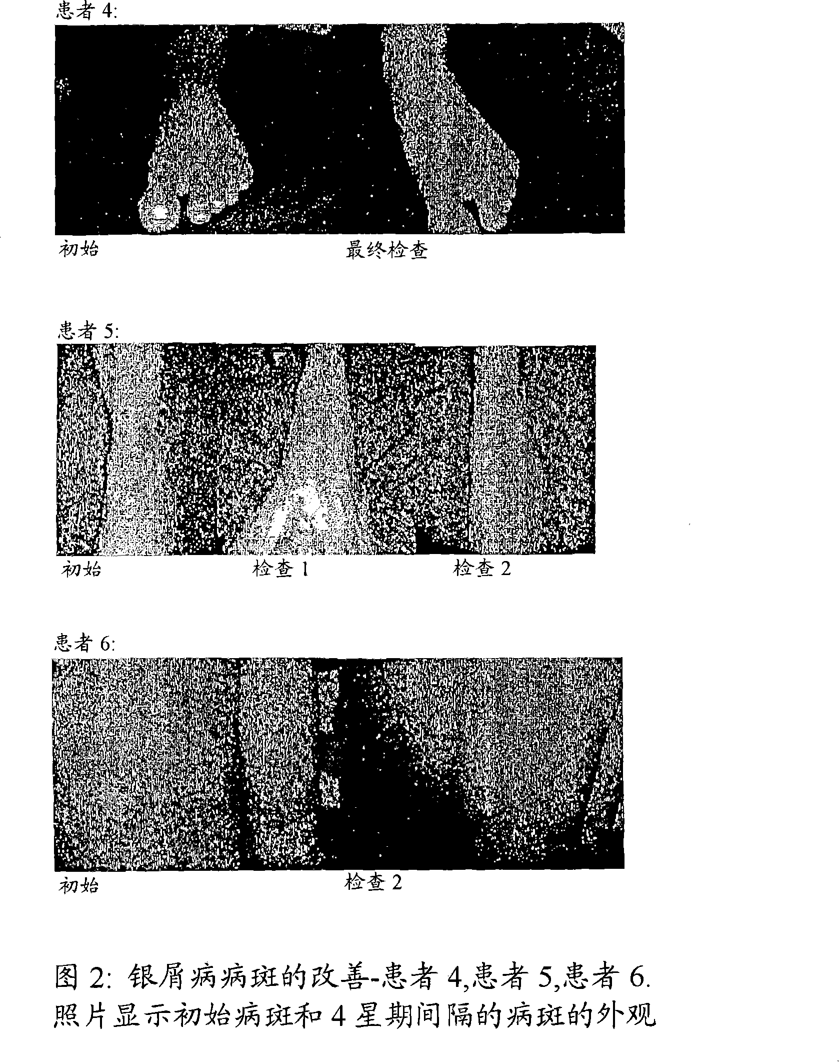 Compositions and methods for the management of hyperproliferative dermatological conditions