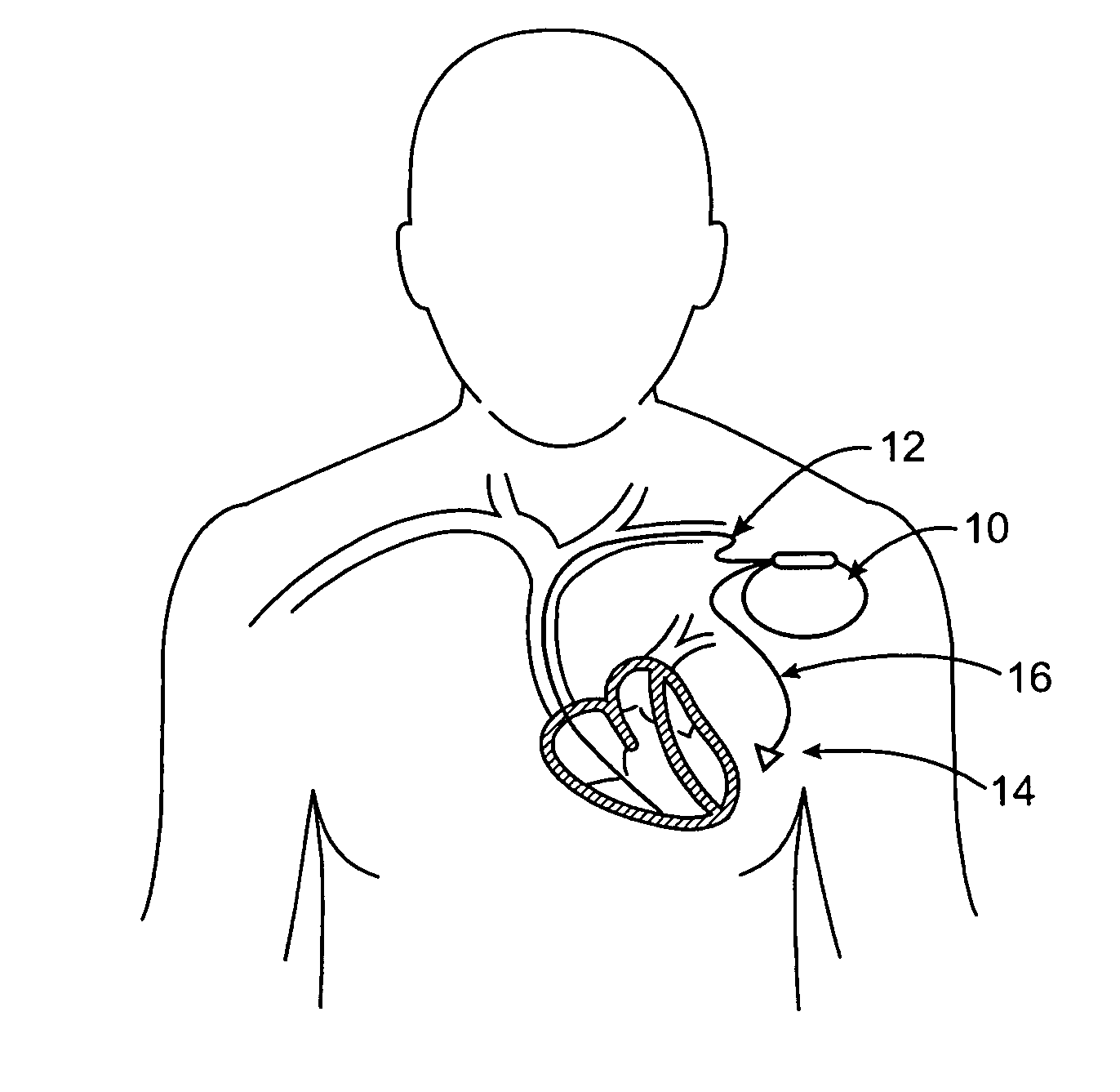 Vibrational therapy device used for resynchronization pacing in a treatment for heart failure