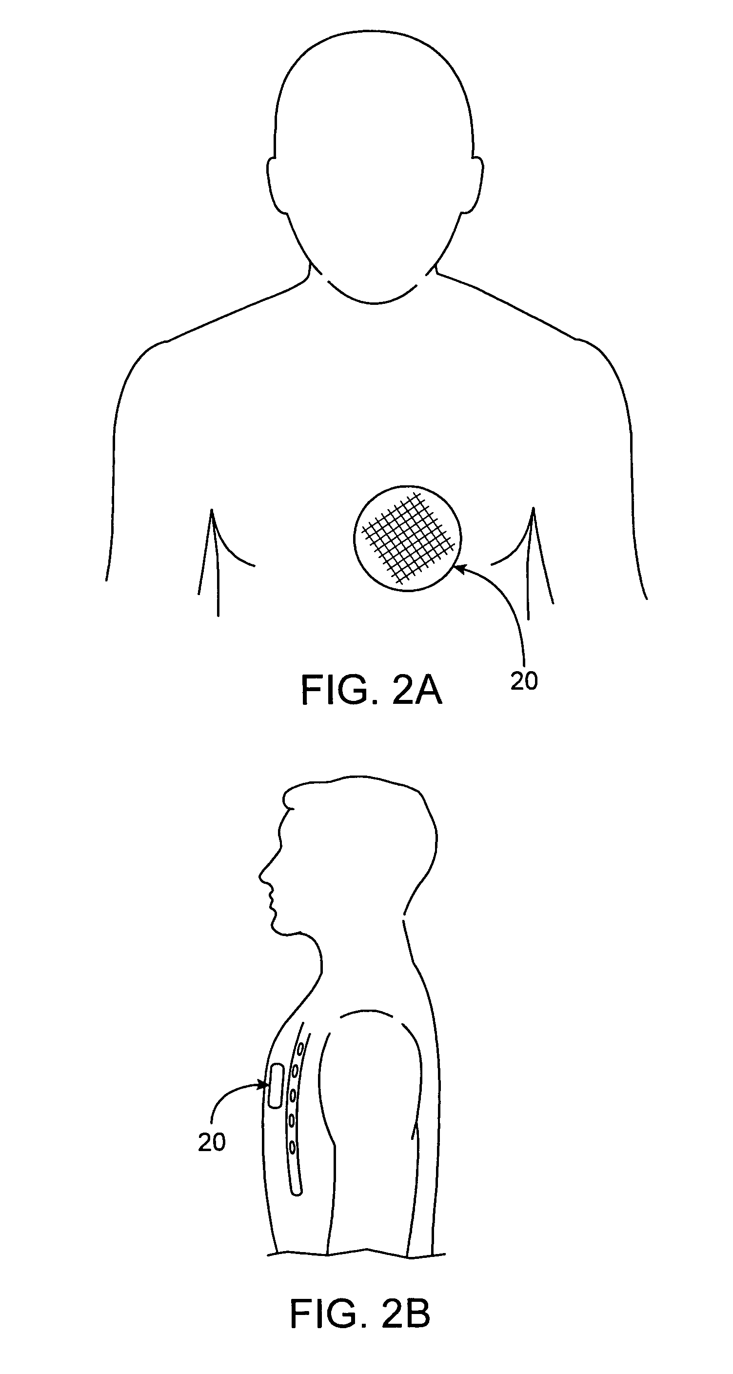 Vibrational therapy device used for resynchronization pacing in a treatment for heart failure