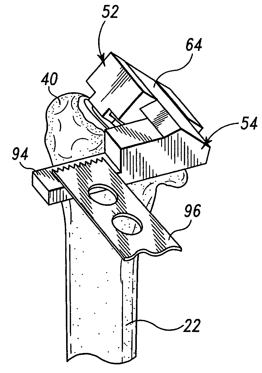 Bone resection apparatus
