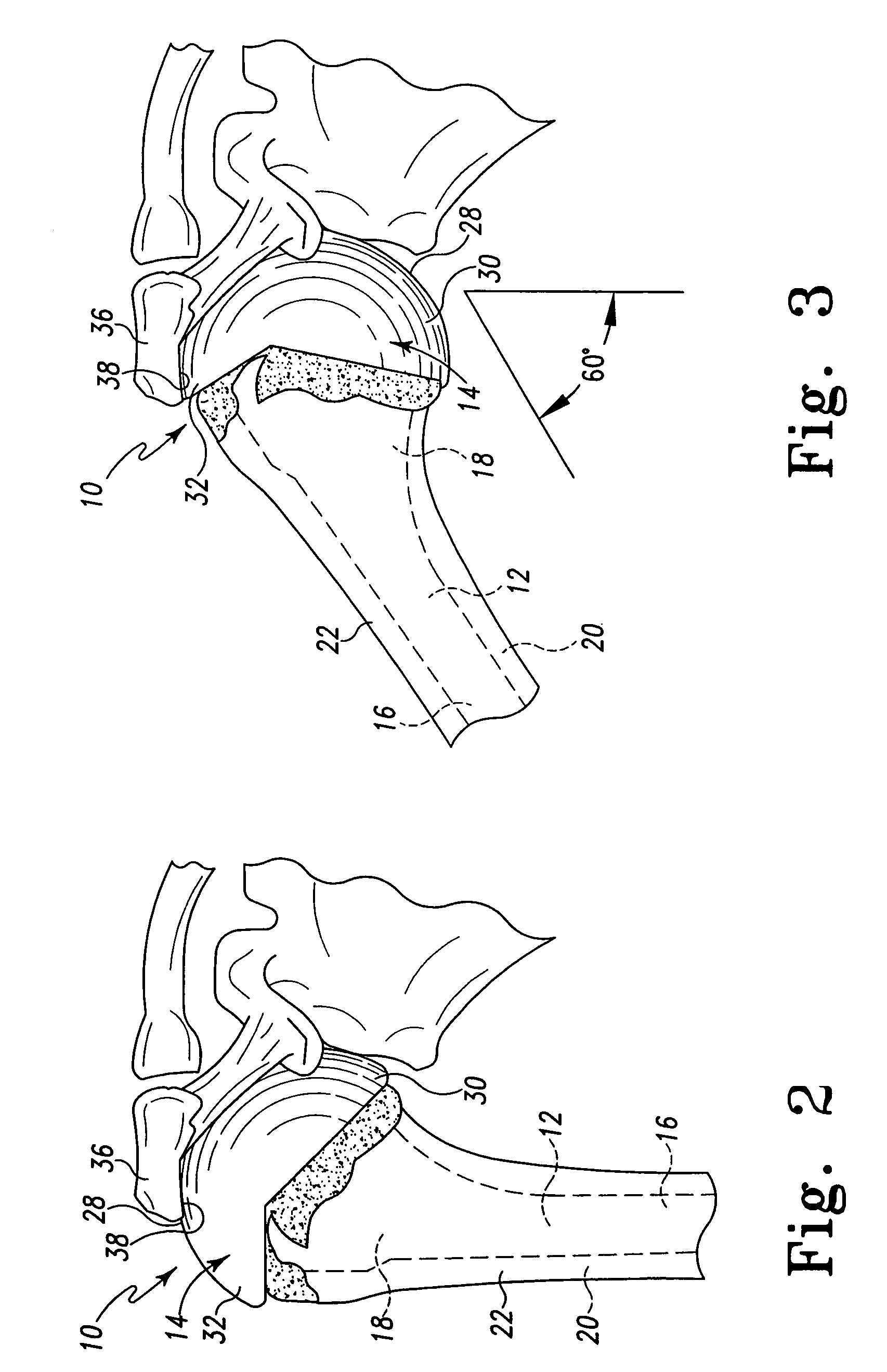 Bone resection apparatus