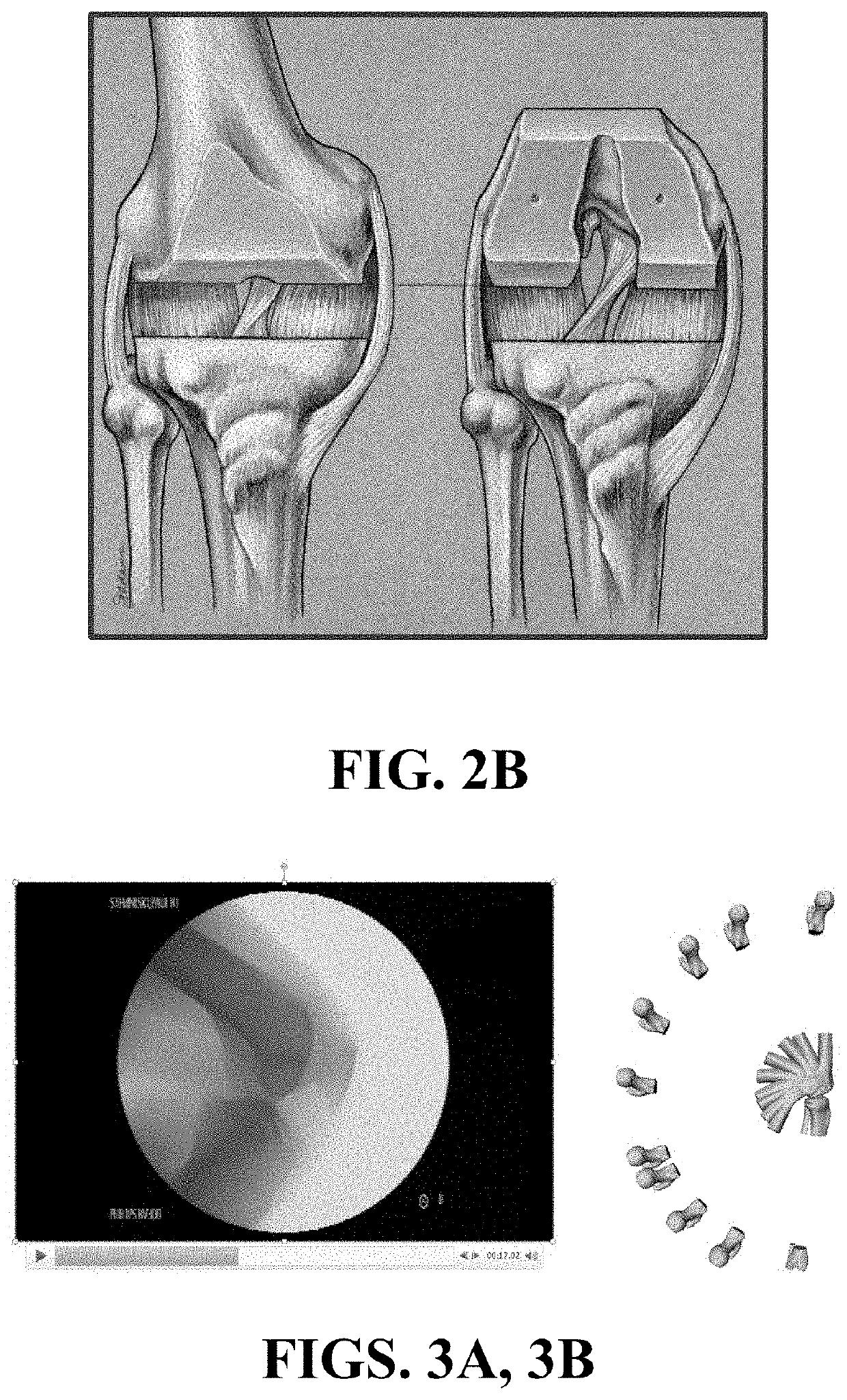 Kinematic Alignment and Novel Femoral and Tibial Prosthetics