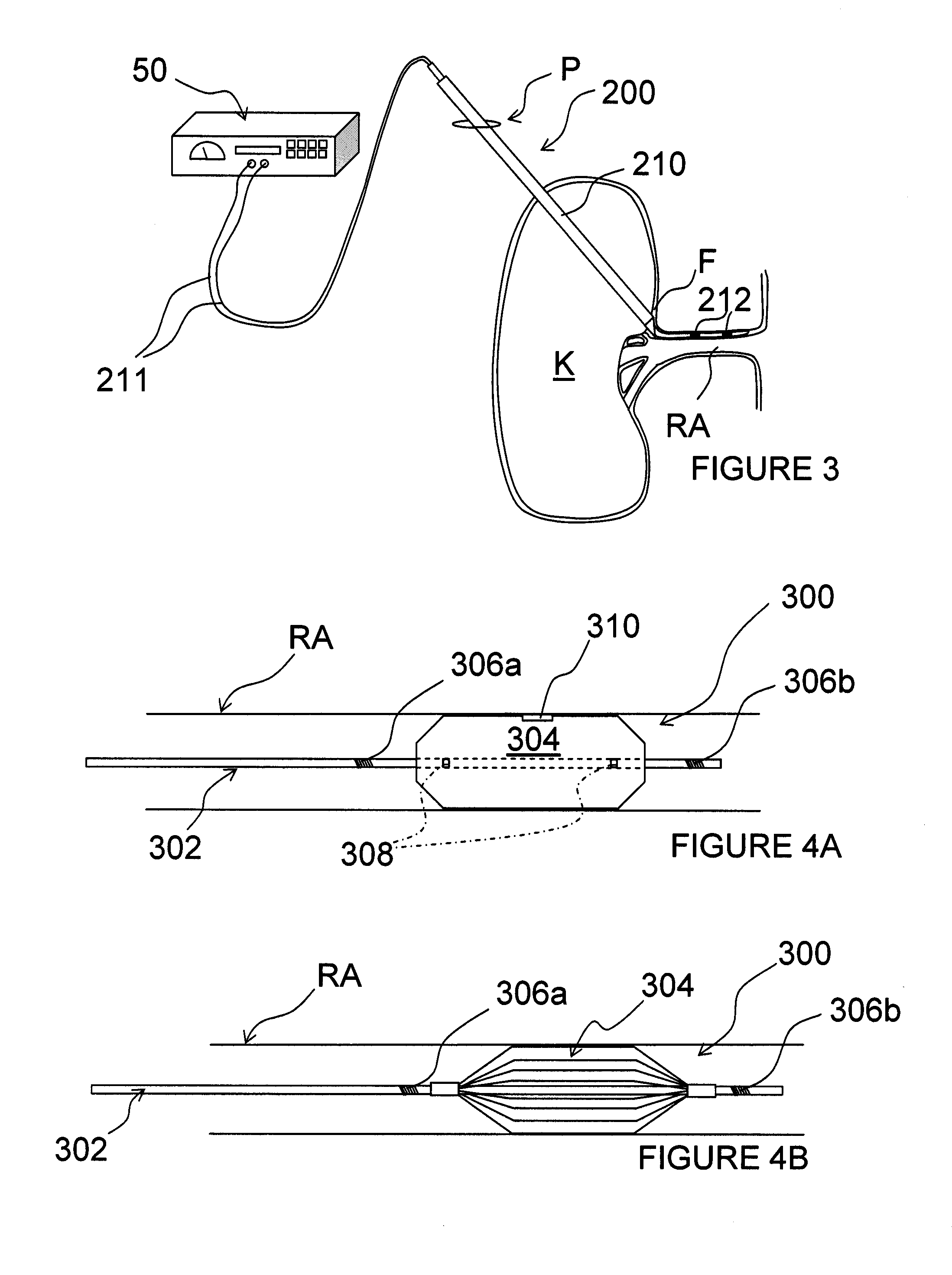 Methods for thermally-induced renal neuromodulation