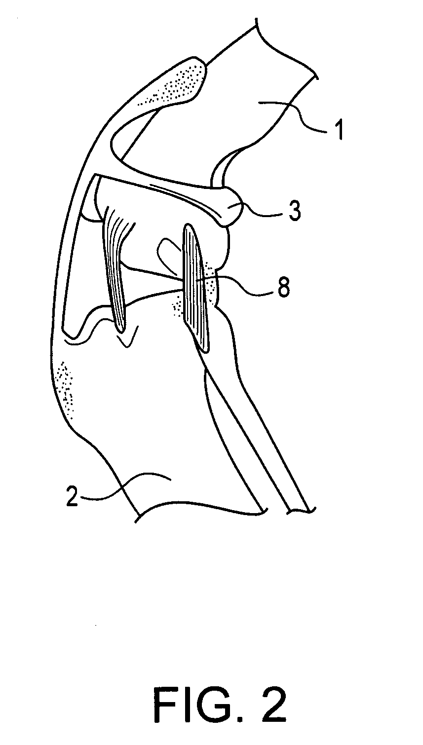 Method and suture-button construct for stabilization of cranial cruciate ligament deficient stifle
