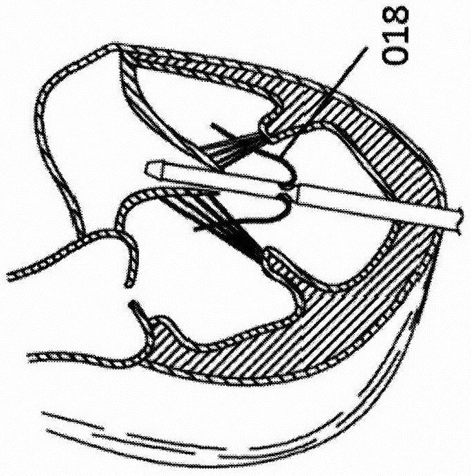 A kind of stent valve prosthesis and delivery system thereof