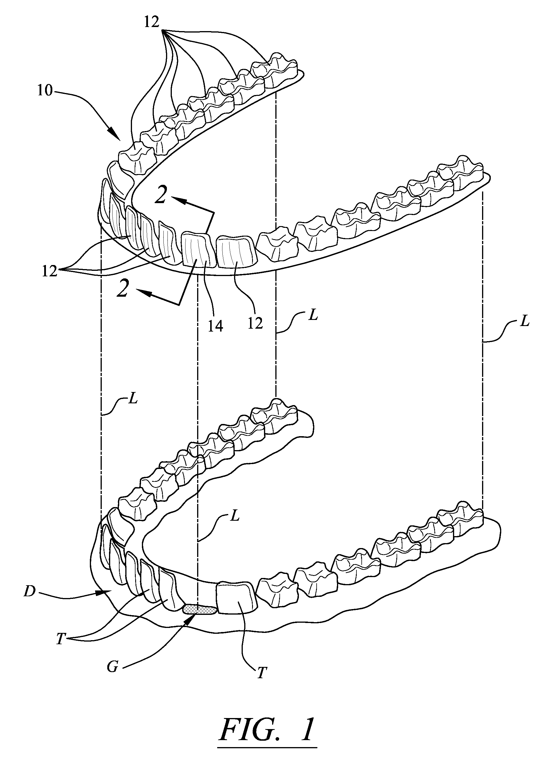Enhancement to dental alignment device