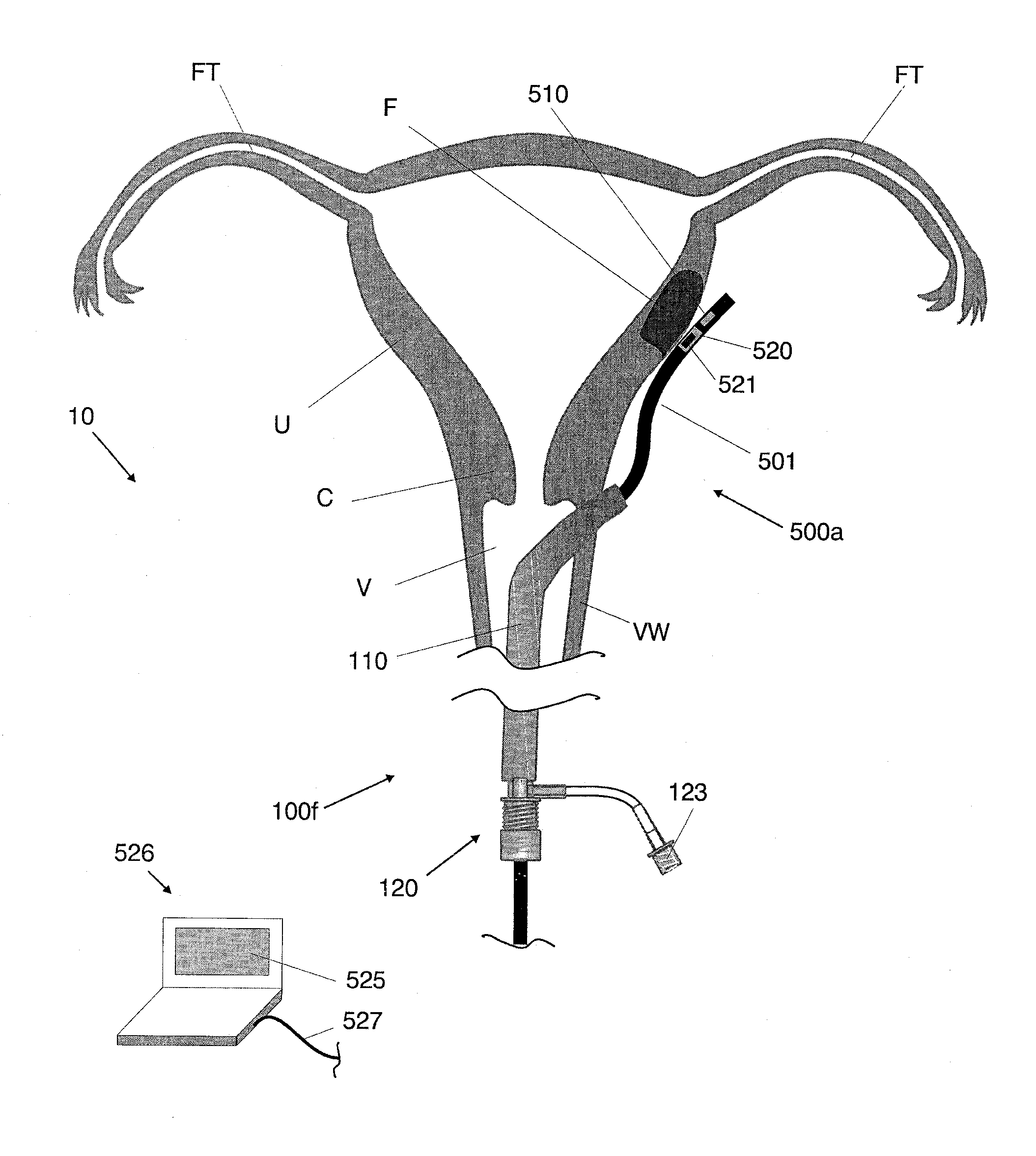 Systems and methods for preventing intravasation during intrauterine procedures