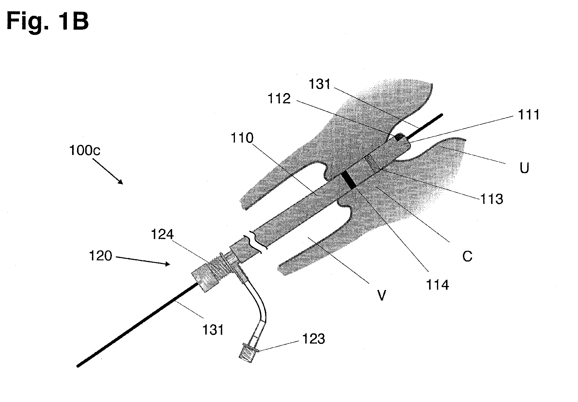 Systems and methods for preventing intravasation during intrauterine procedures