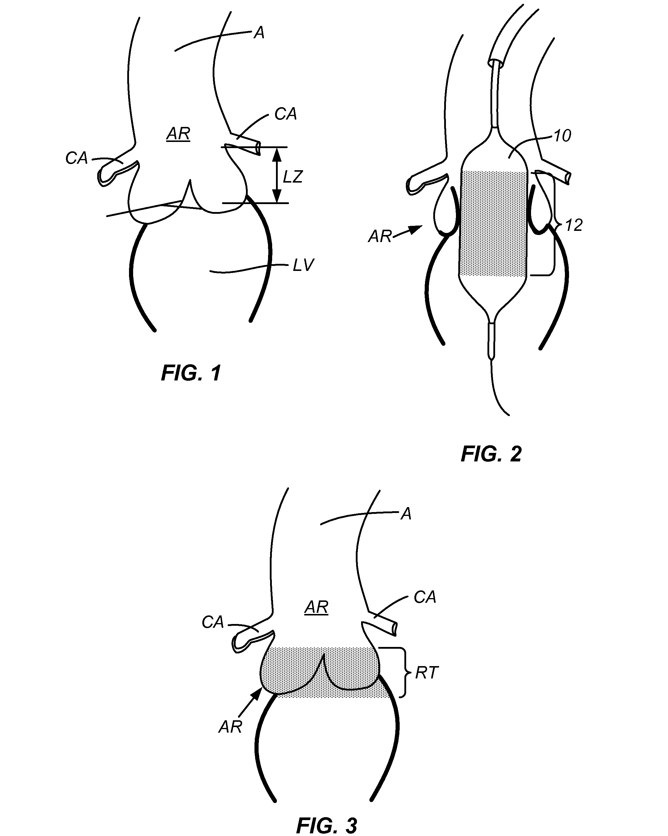 Device and methods for delivery and transfer of temporary radiopaque element