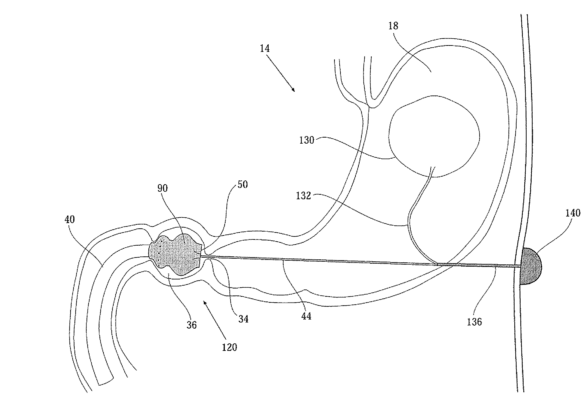 Duodenal liner device