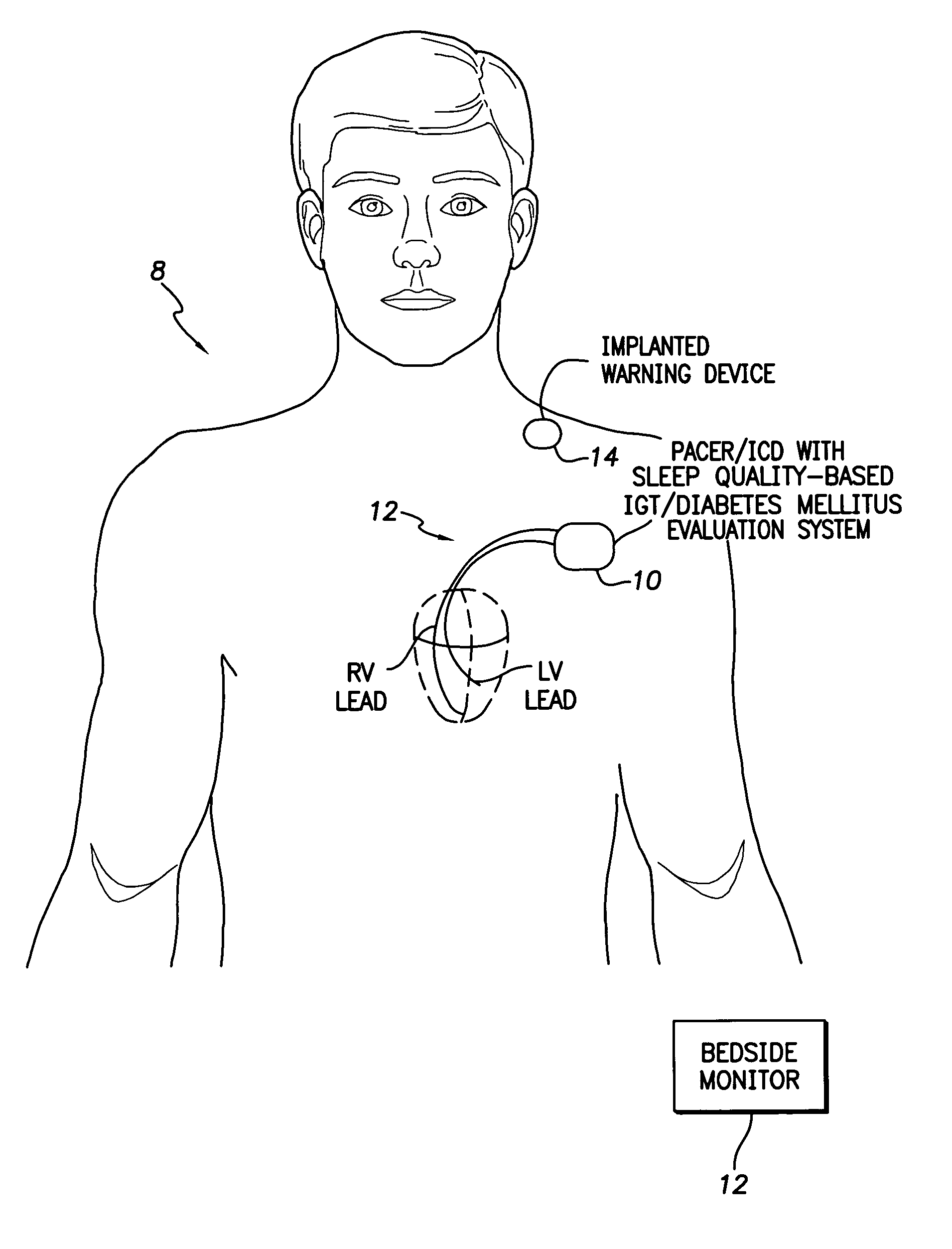 System and method for evaluating impaired glucose tolerance and diabetes mellitus within a patient using an implantable medical device