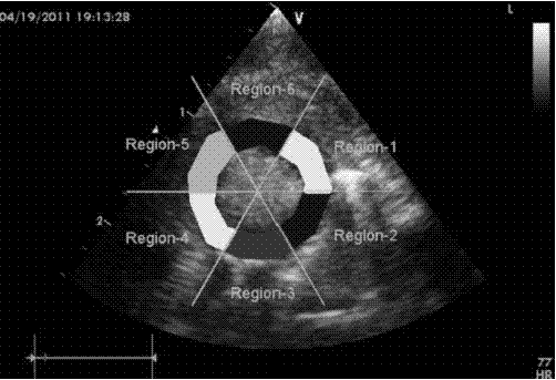 Method for measuring myocardium ultrasonic angiography image physiological parameters based on empirical mode decomposition (EMD)