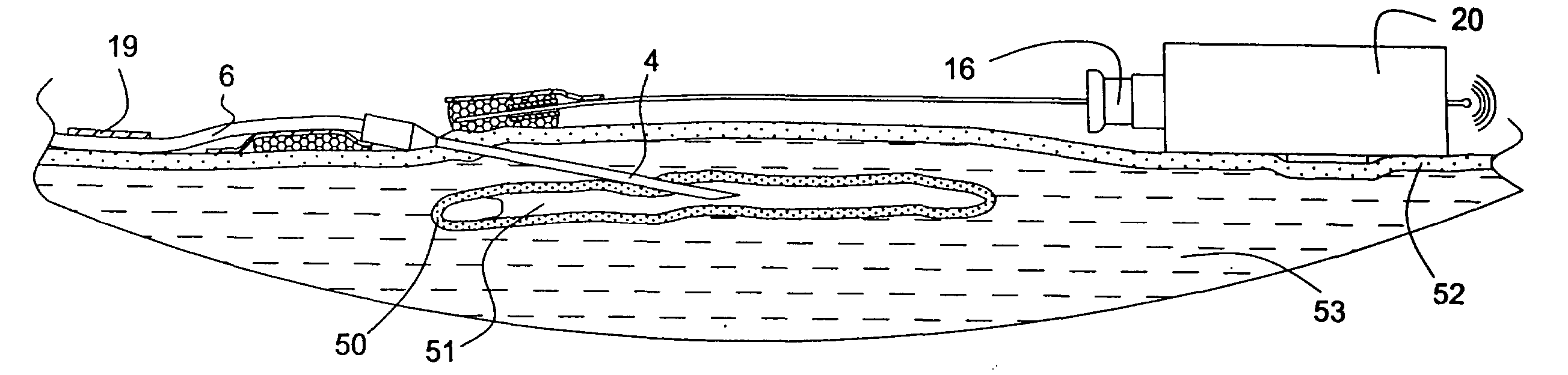 Means and Method for Detection of Blood Leakage from Wounds