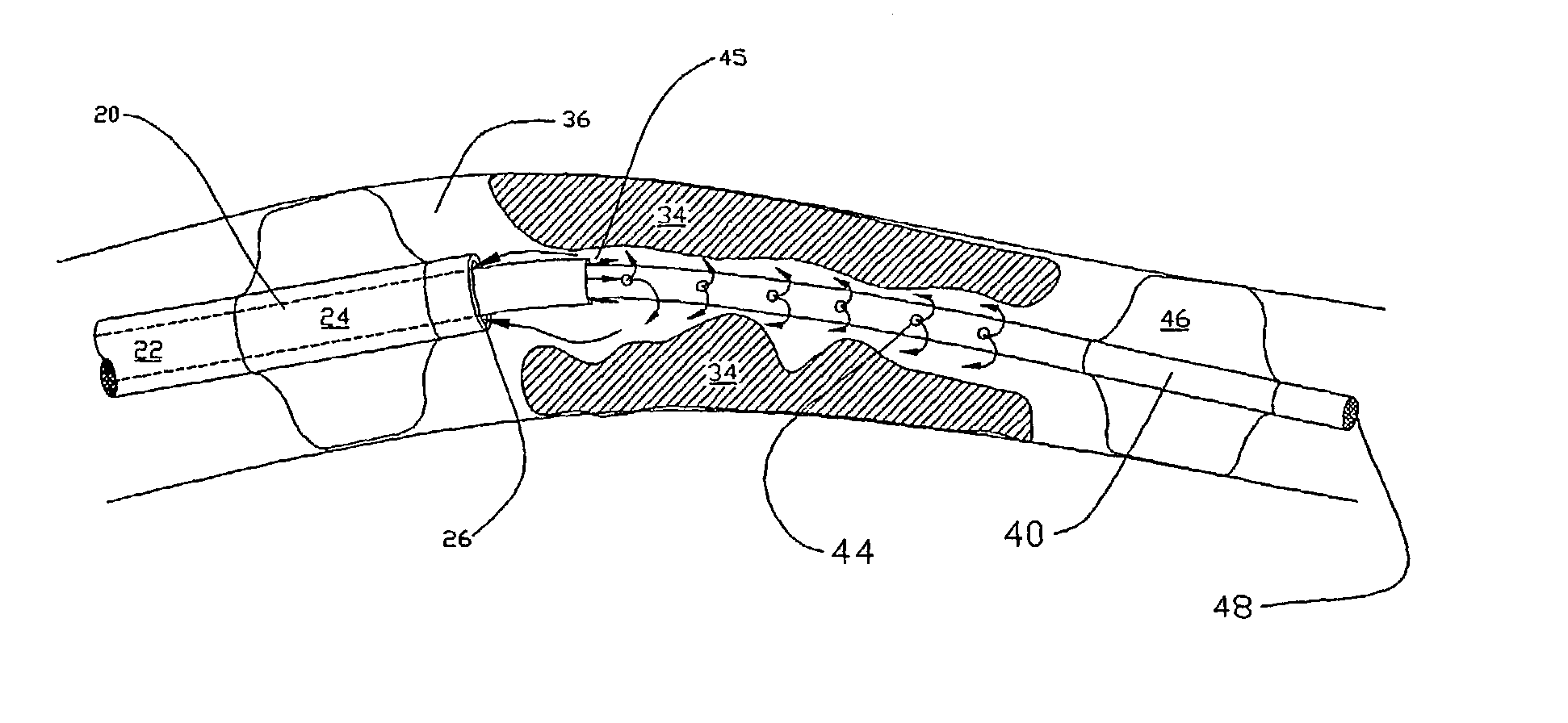 Methods for enhancing fluid flow through an obstructed vascular site, and systems and kits for use in practicing the same