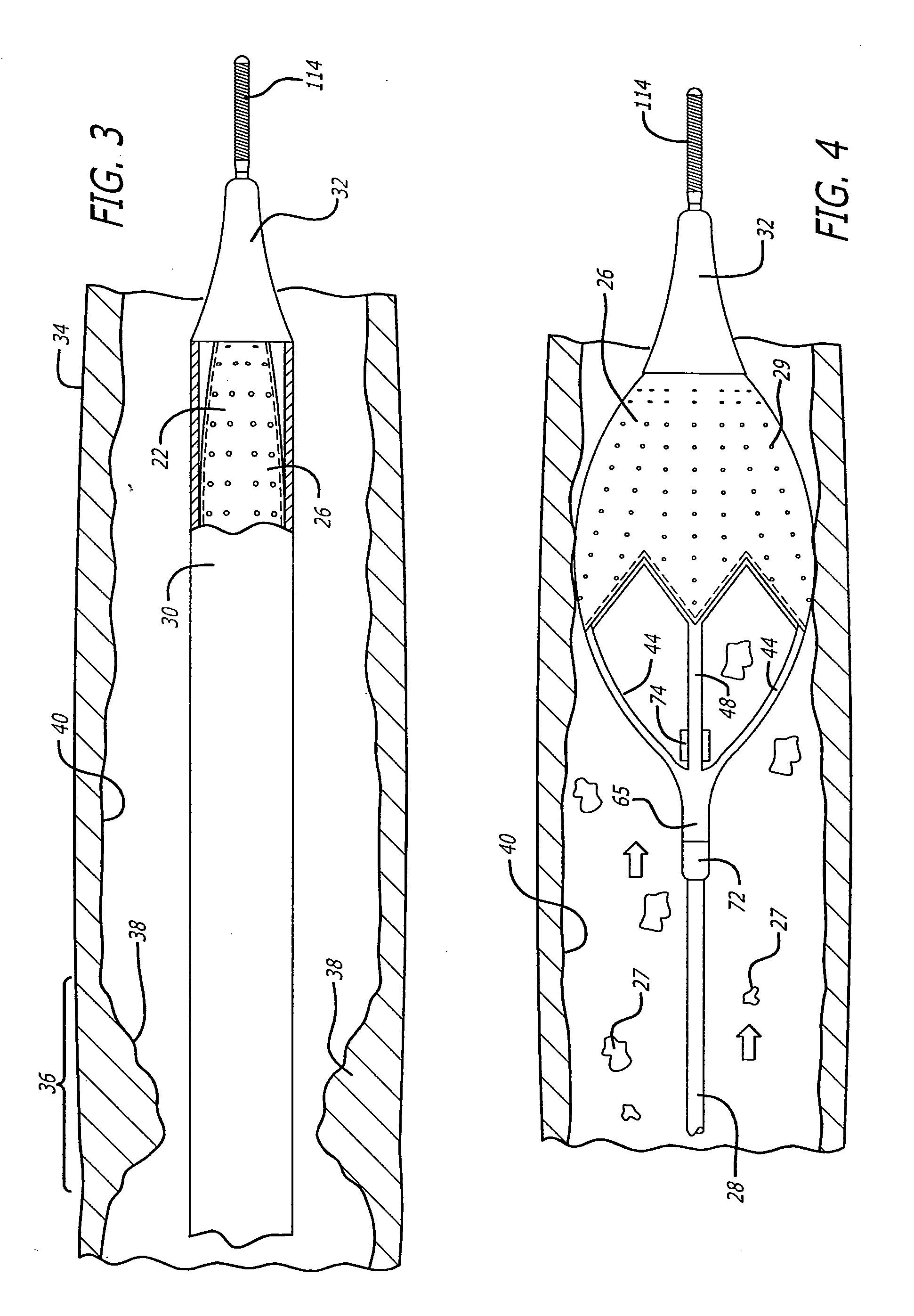 Expandable cages for embolic filtering devices