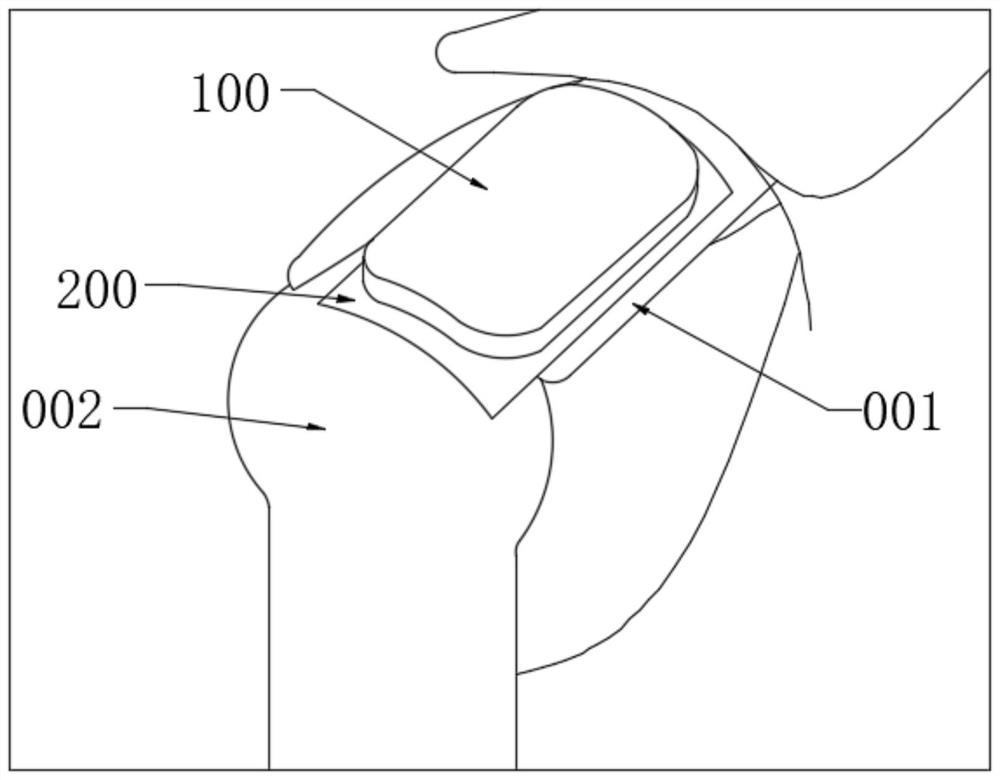 Repair device for shoulder joint and prosthesis system