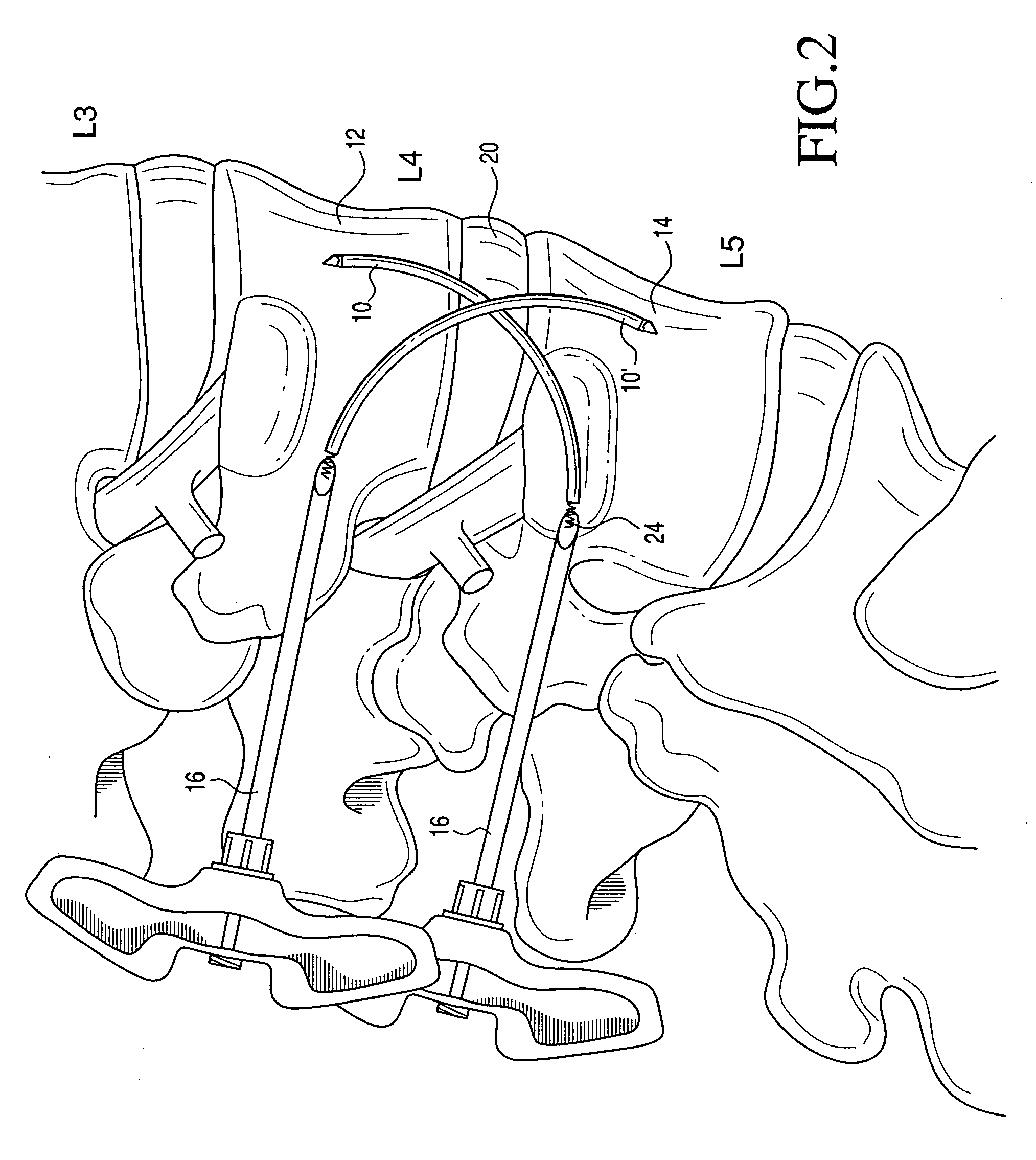 Percutaneous spinal stabilization device and method