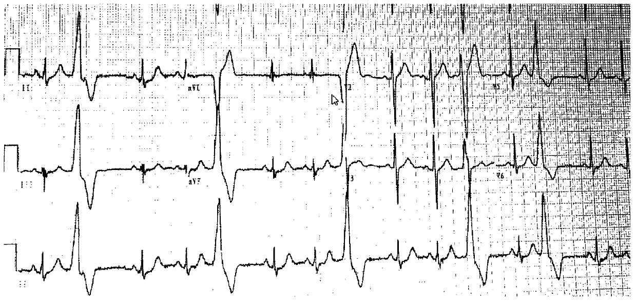 Electrocardio analysis method and device based on picture and heart beat information, equipment and medium