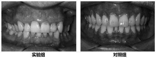 A jelly-like mouthwash with anti-caries, antibacterial and strong root tooth-fixing effects