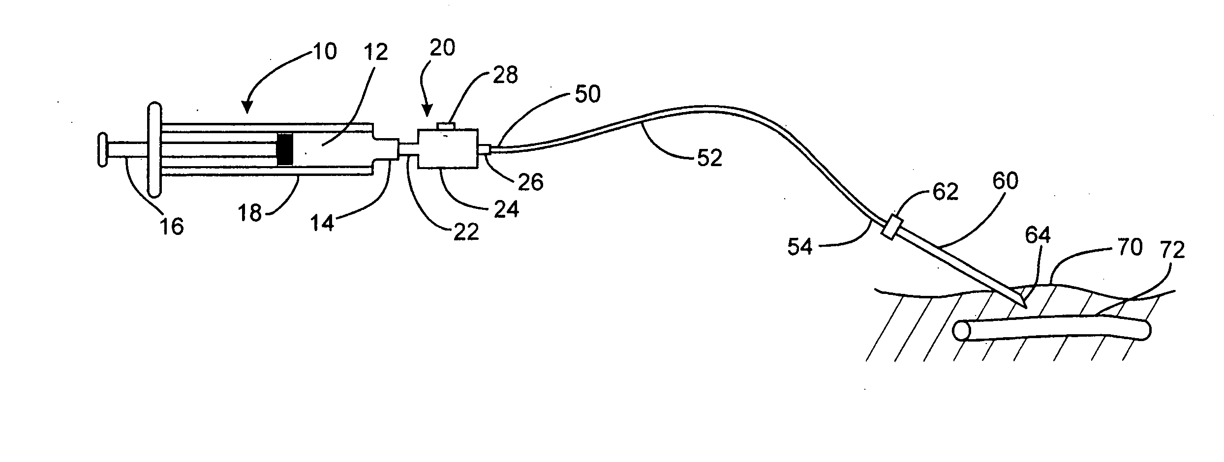 Method and apparatus to decrease the risk of intraneuronal injection during administration of nerve block anesthesia