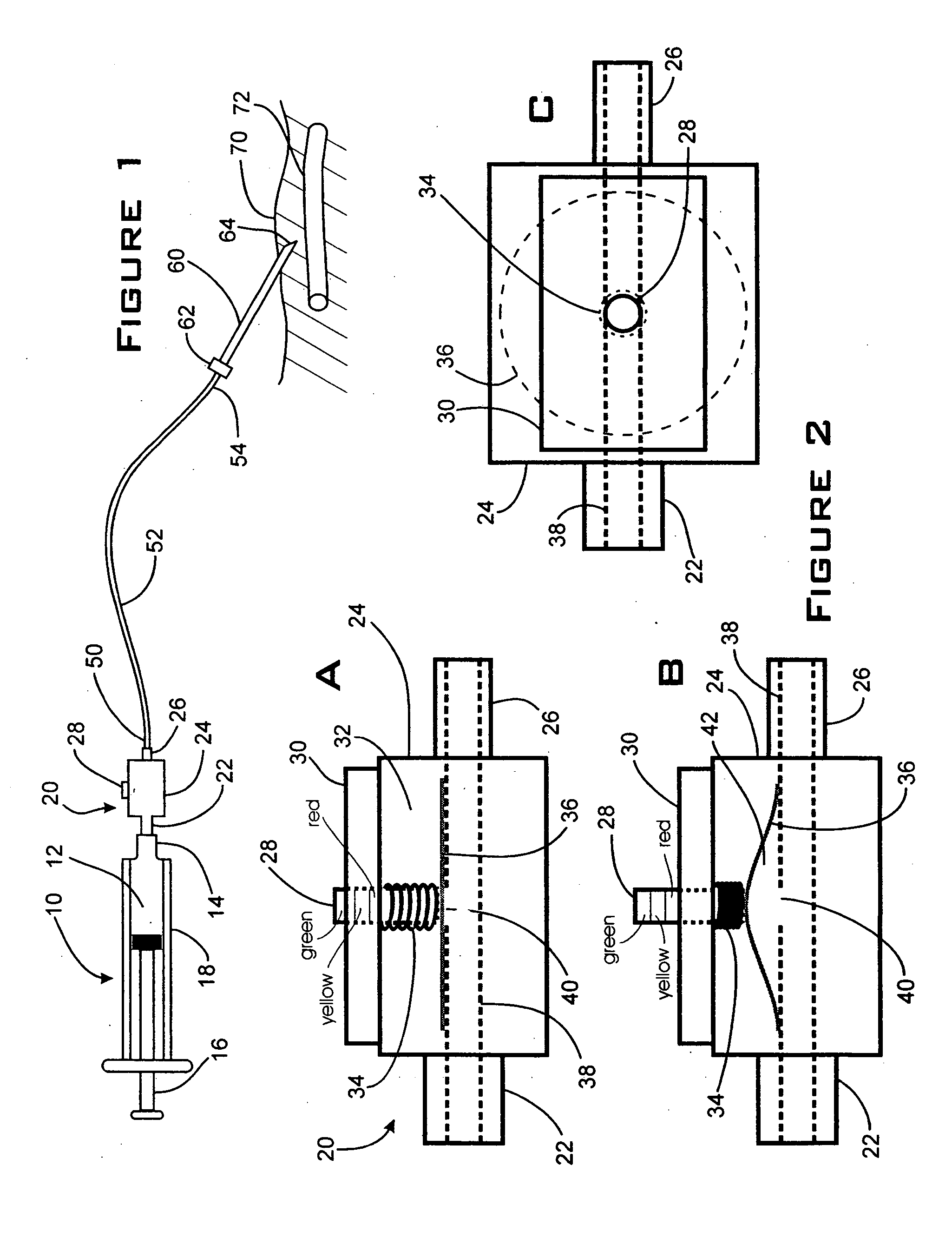 Method and apparatus to decrease the risk of intraneuronal injection during administration of nerve block anesthesia