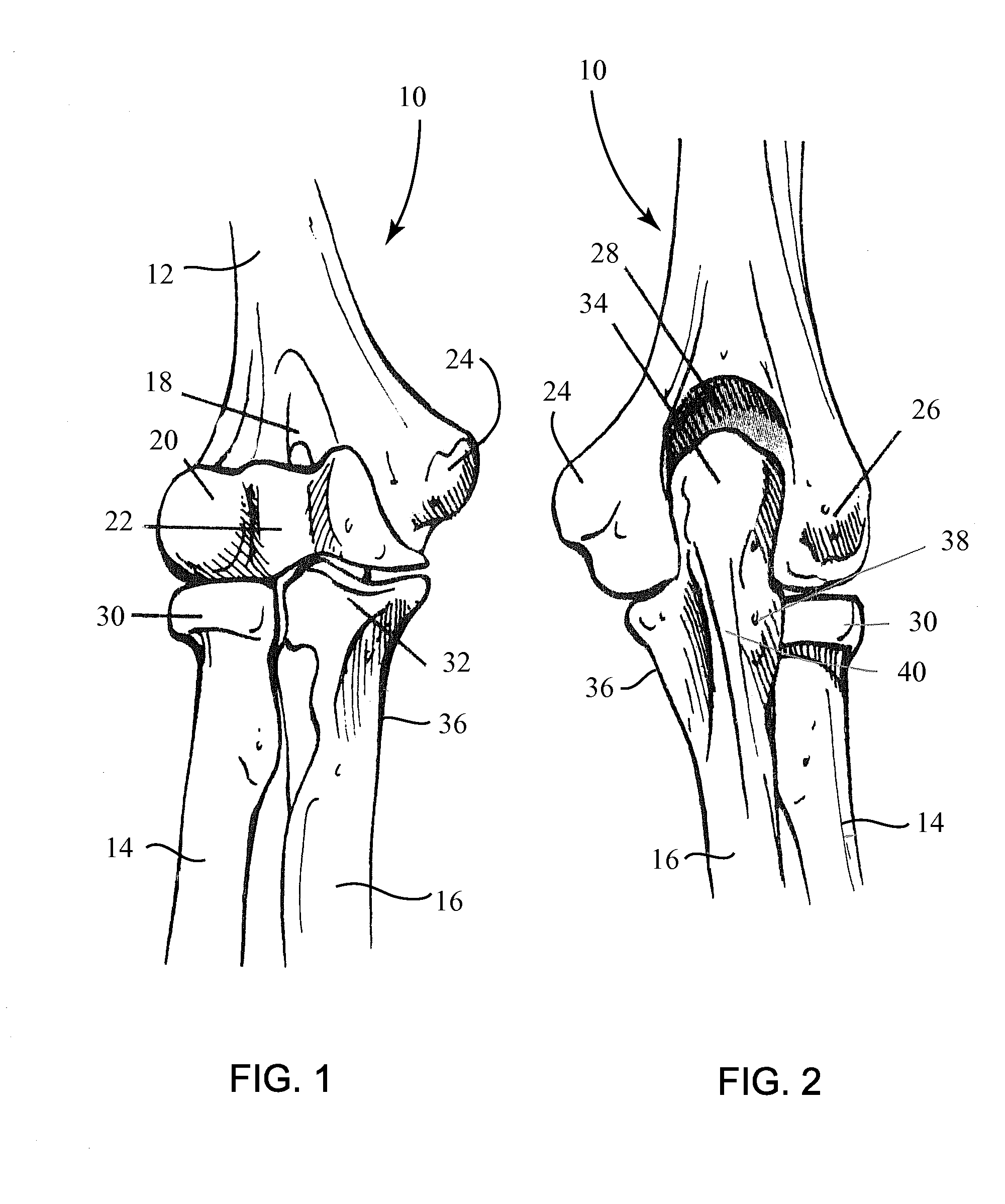 Fracture Fixation Plate for the Coronoid of the Proximal Ulna