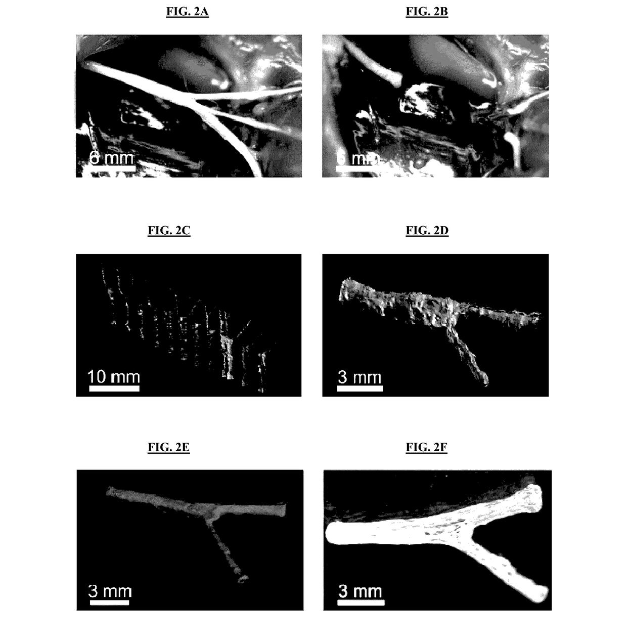 3D printed patient-specific conduits for treating complex peripheral nerve injury