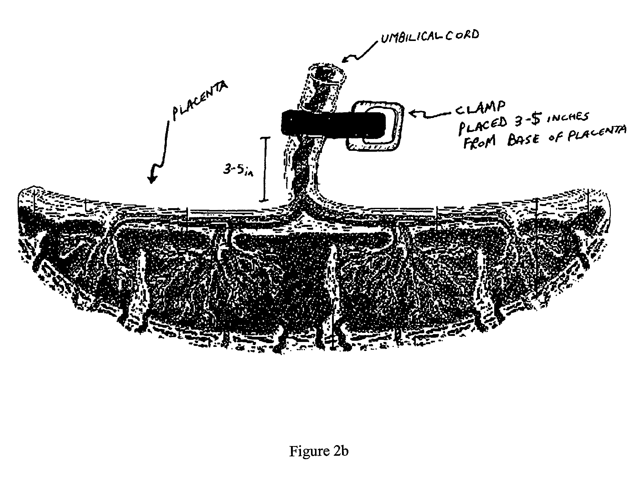 Method of collecting placental stem cells