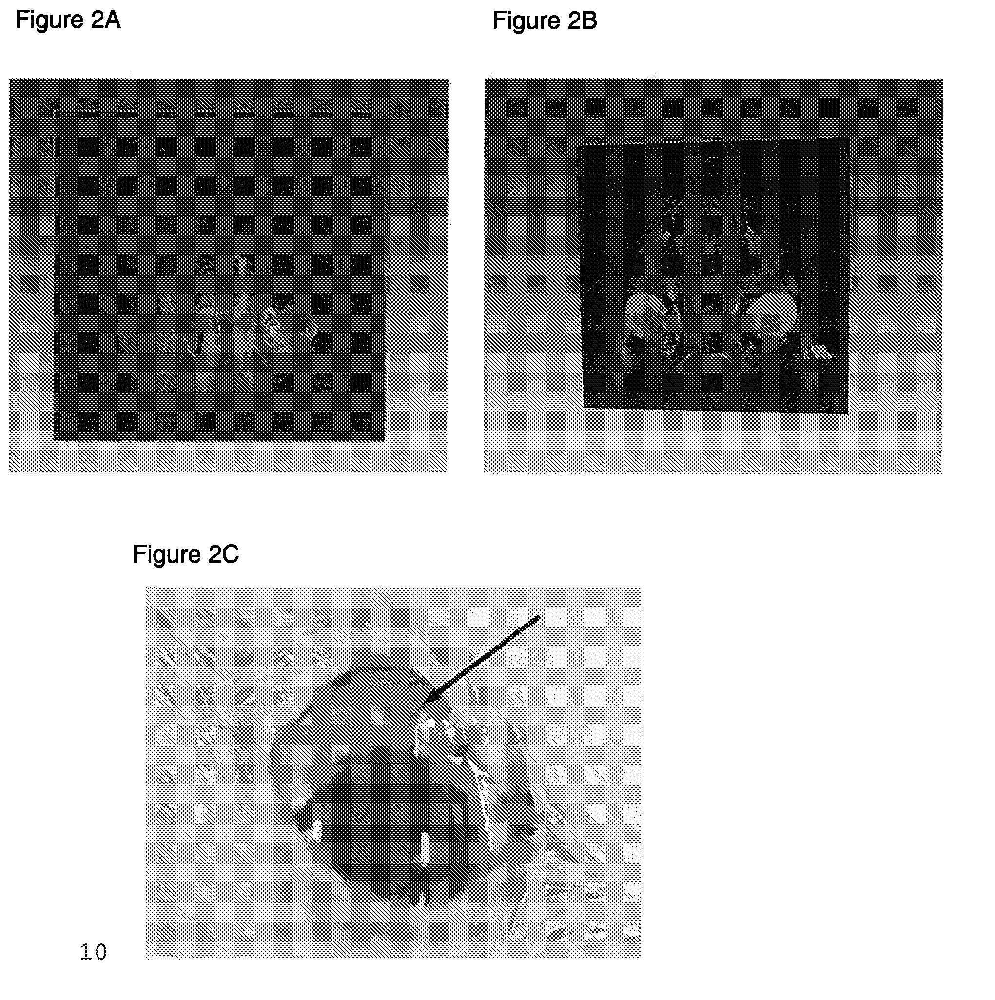 Drug delivery systems and methods for treating neovascularization