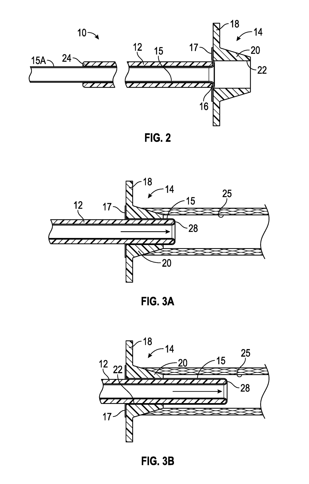 Urinary catheter assembly and method