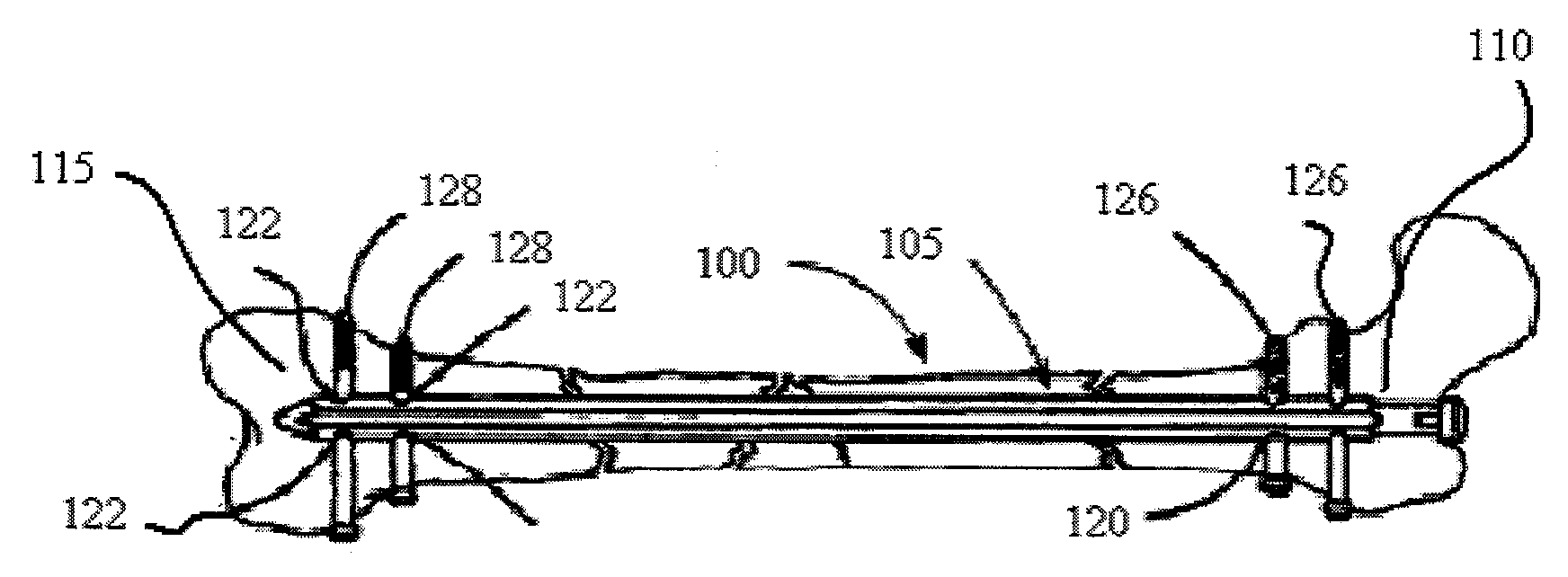 System and method for securing surgical implant