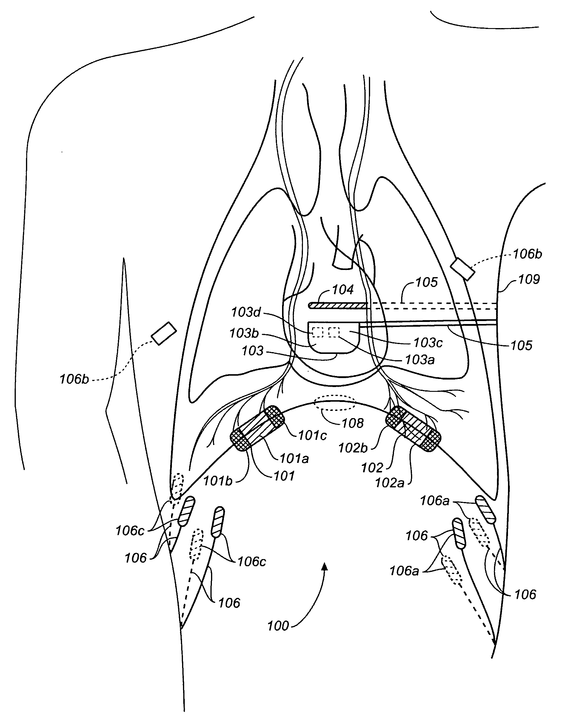 Subcutaneous diaphragm stimulation device and method for use