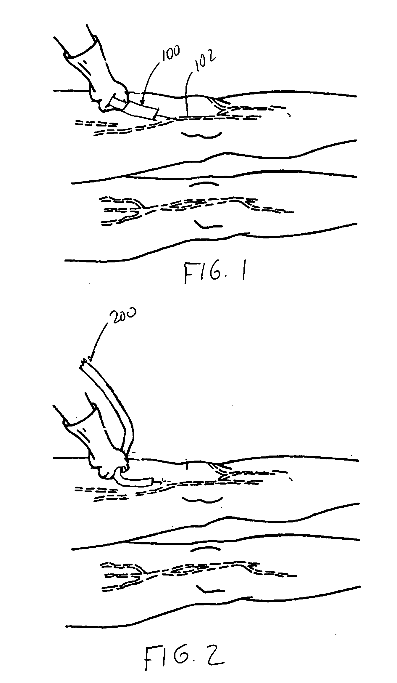 Apparatus and methods for treating undesired veins