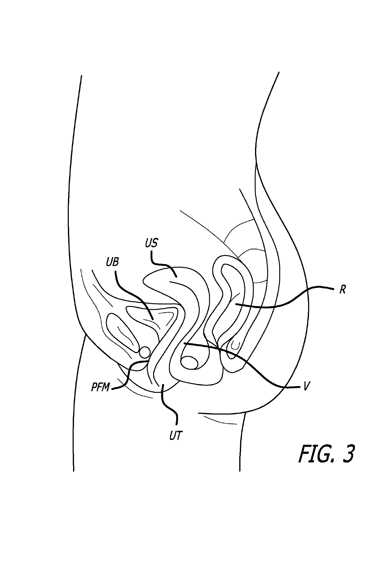 System for delivering anchors for treating incontinence