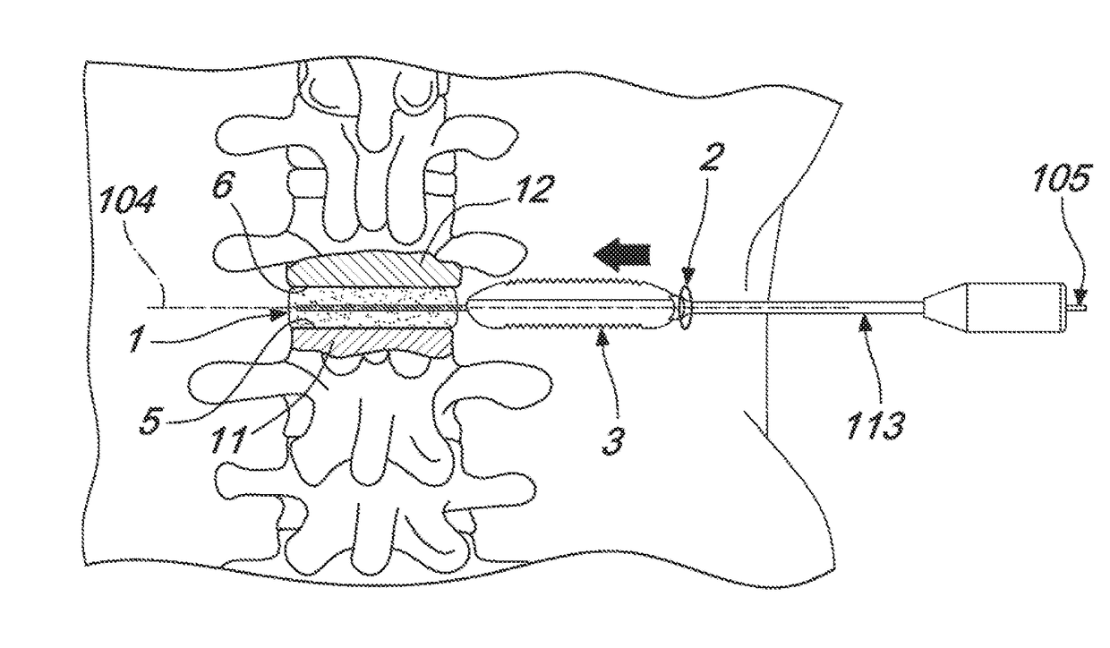 Intervertebral prosthesis, apparatus for implanting intervertebral prostheses and surgical method for implanting intervertebral prostheses, particularly for percutaneous minimally-invasive surgical procedures